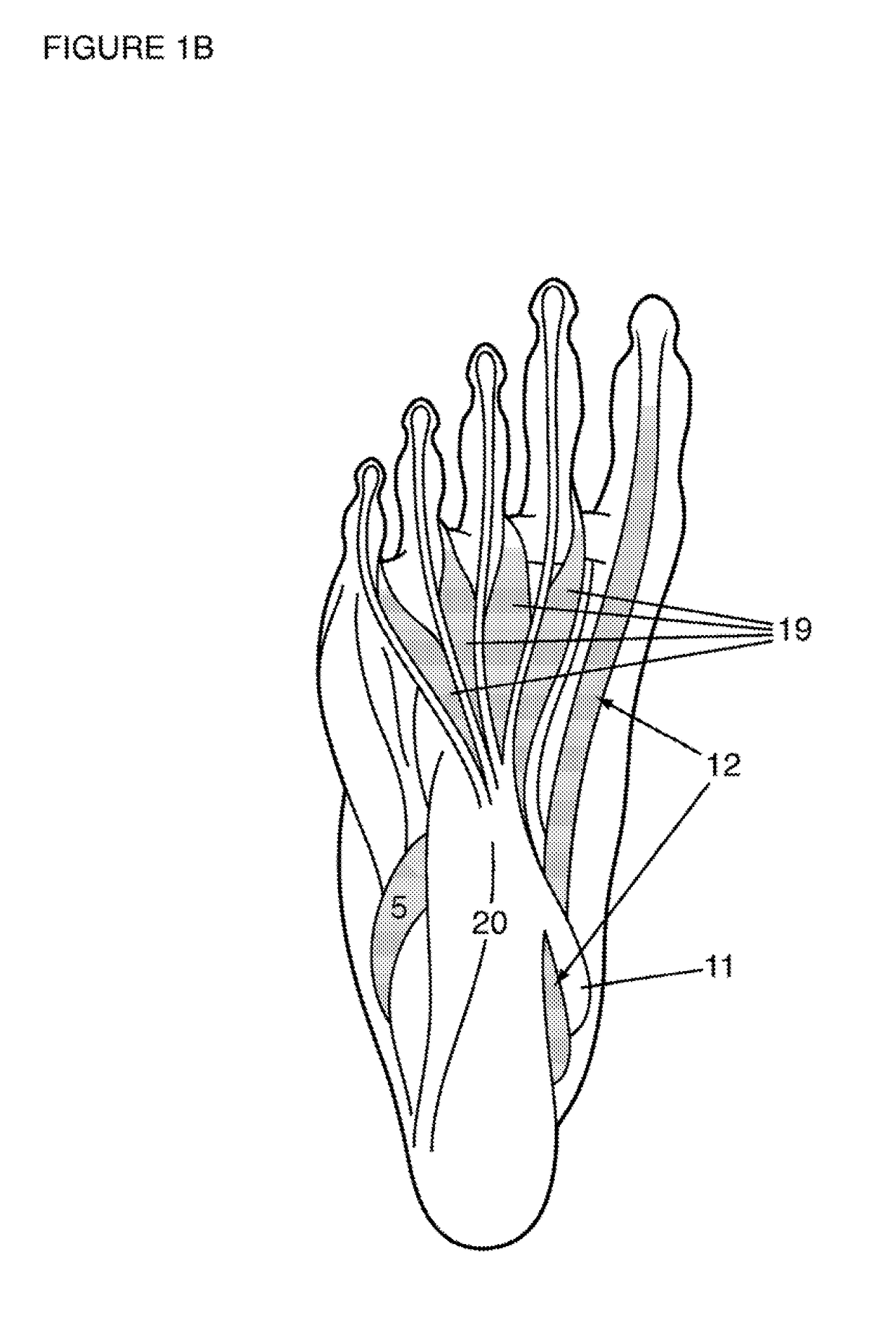 Programmable electrical stimulation of the foot muscles