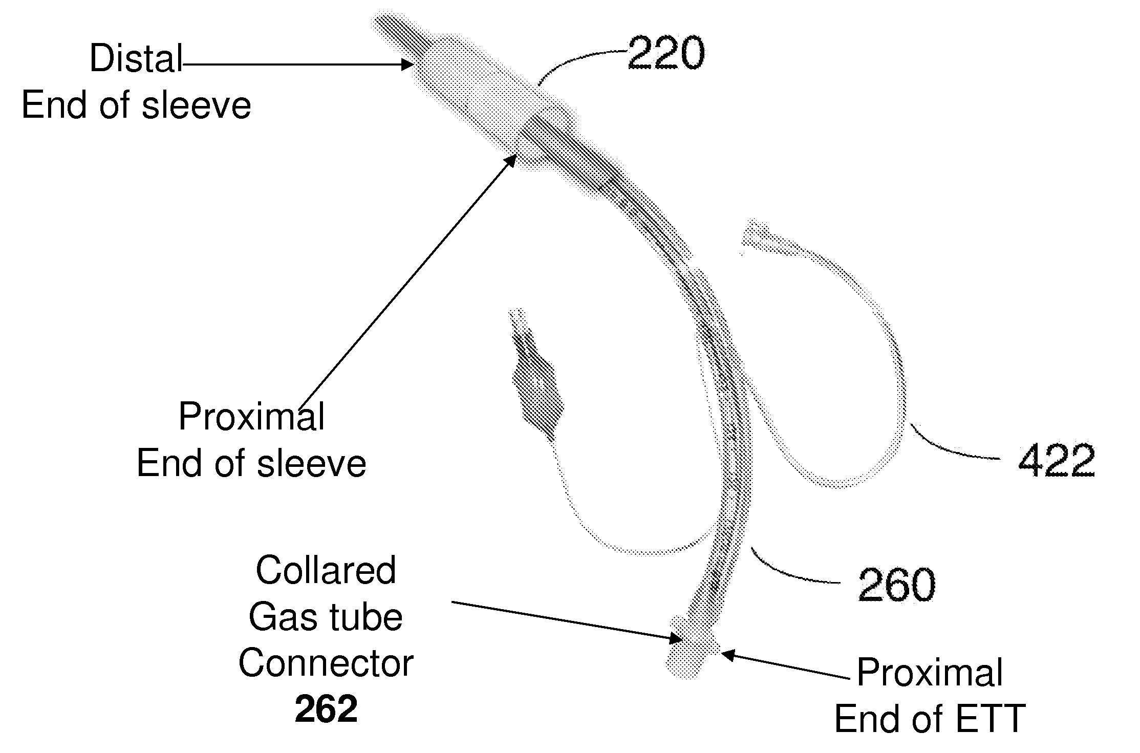 Method and apparatus for blocking fluid flow in an intubated trachea