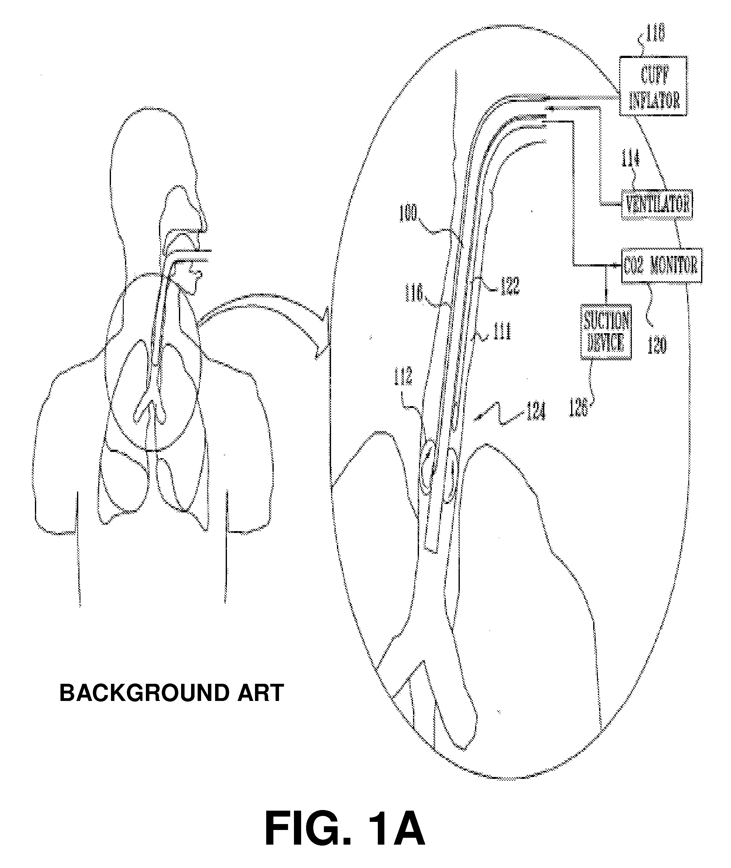 Method and apparatus for blocking fluid flow in an intubated trachea