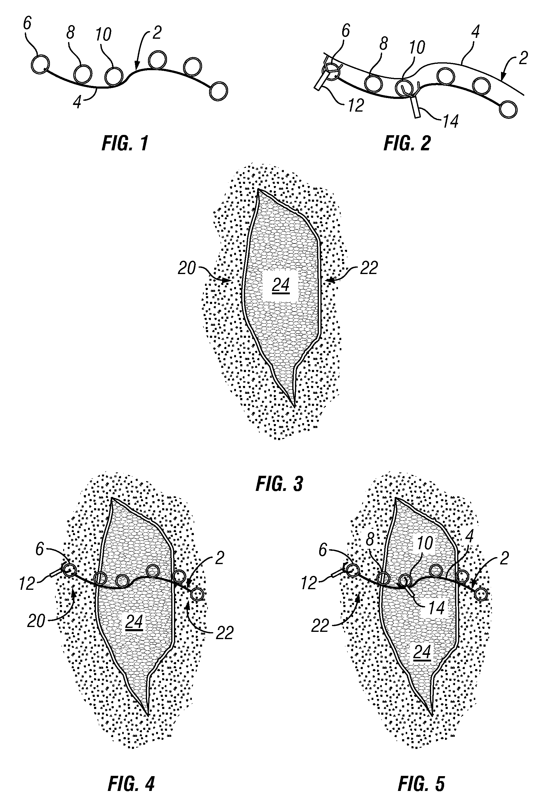 Tissue Approximator and Retractor Assistive Device