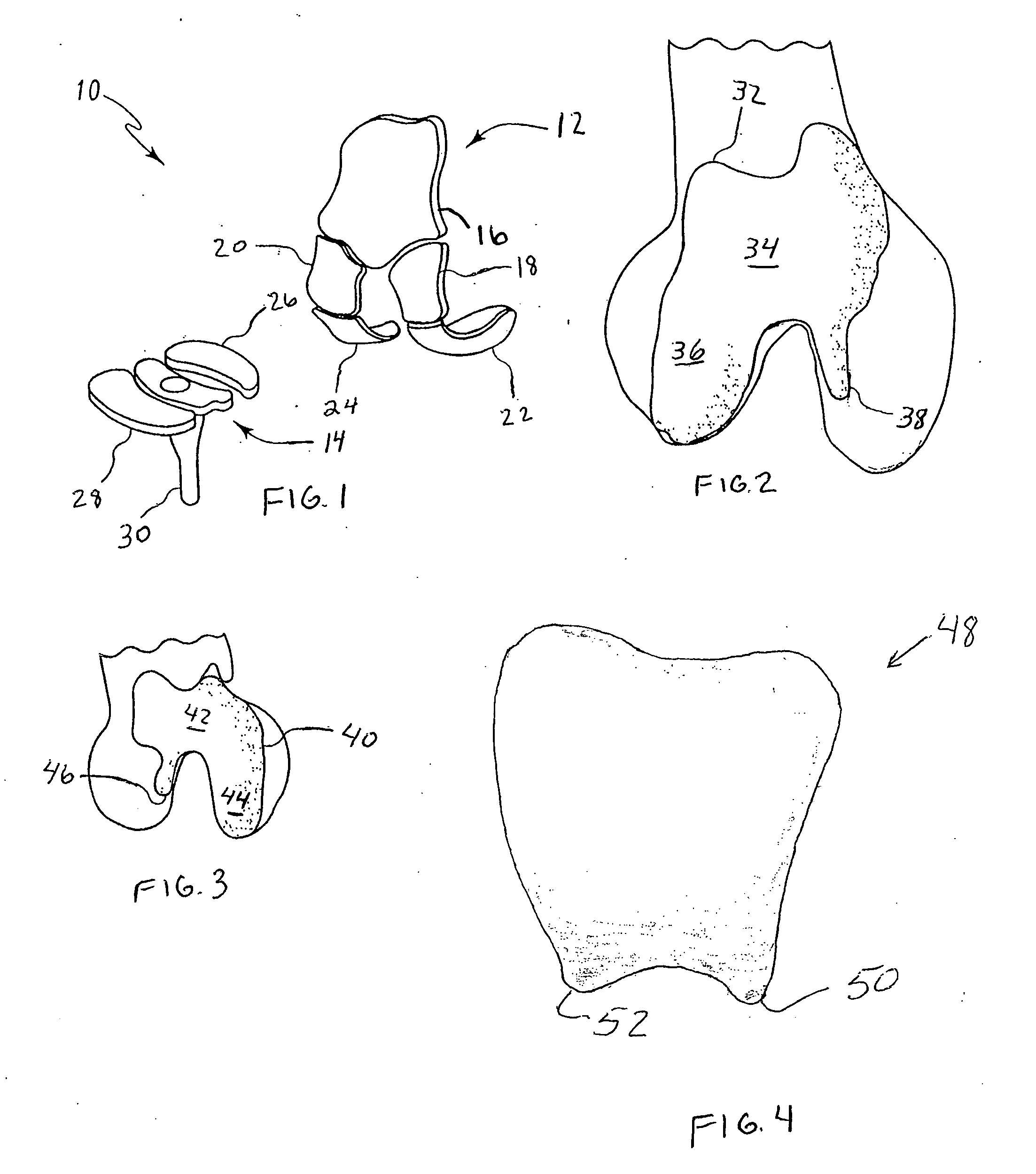 Systems and methods for compartmental replacement in a knee