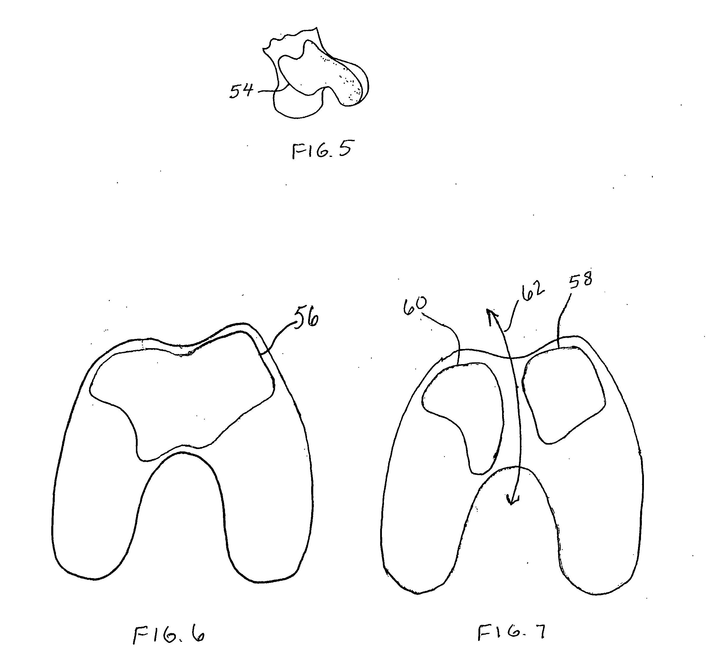 Systems and methods for compartmental replacement in a knee