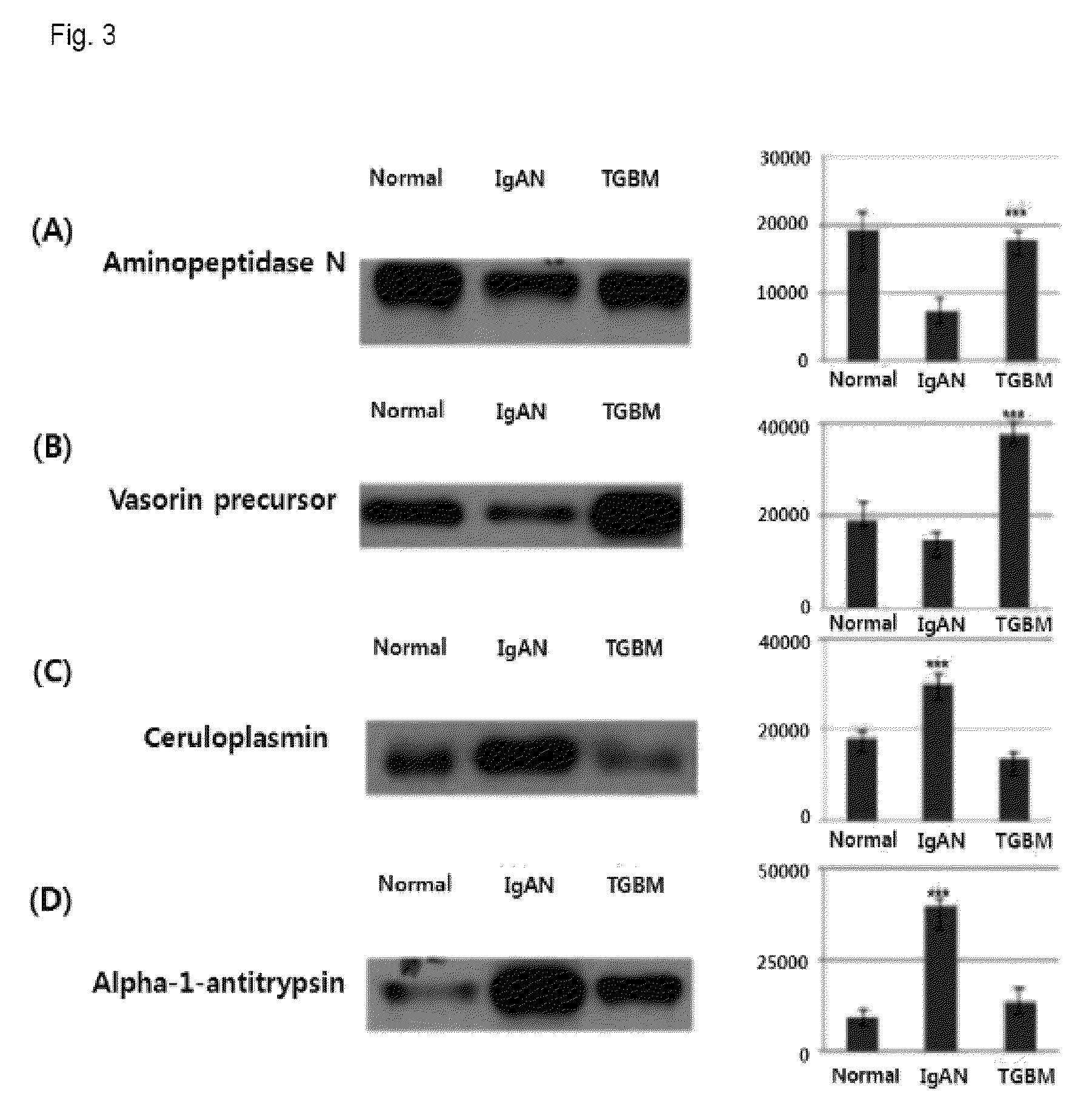 Method for diagnosing immunoglobulin A nephropathy and TGBM nephropathy