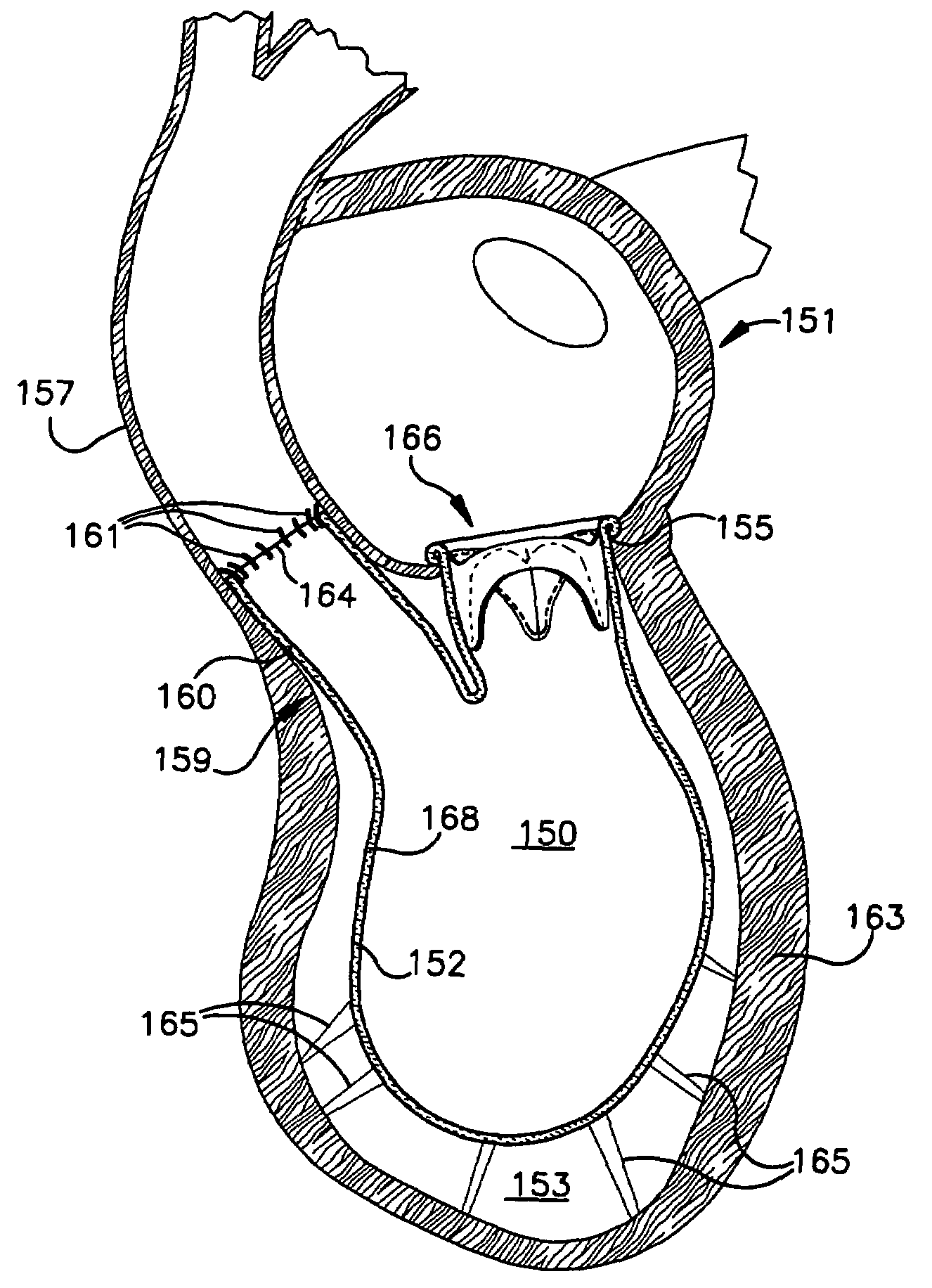 System and method for improving ventricular function