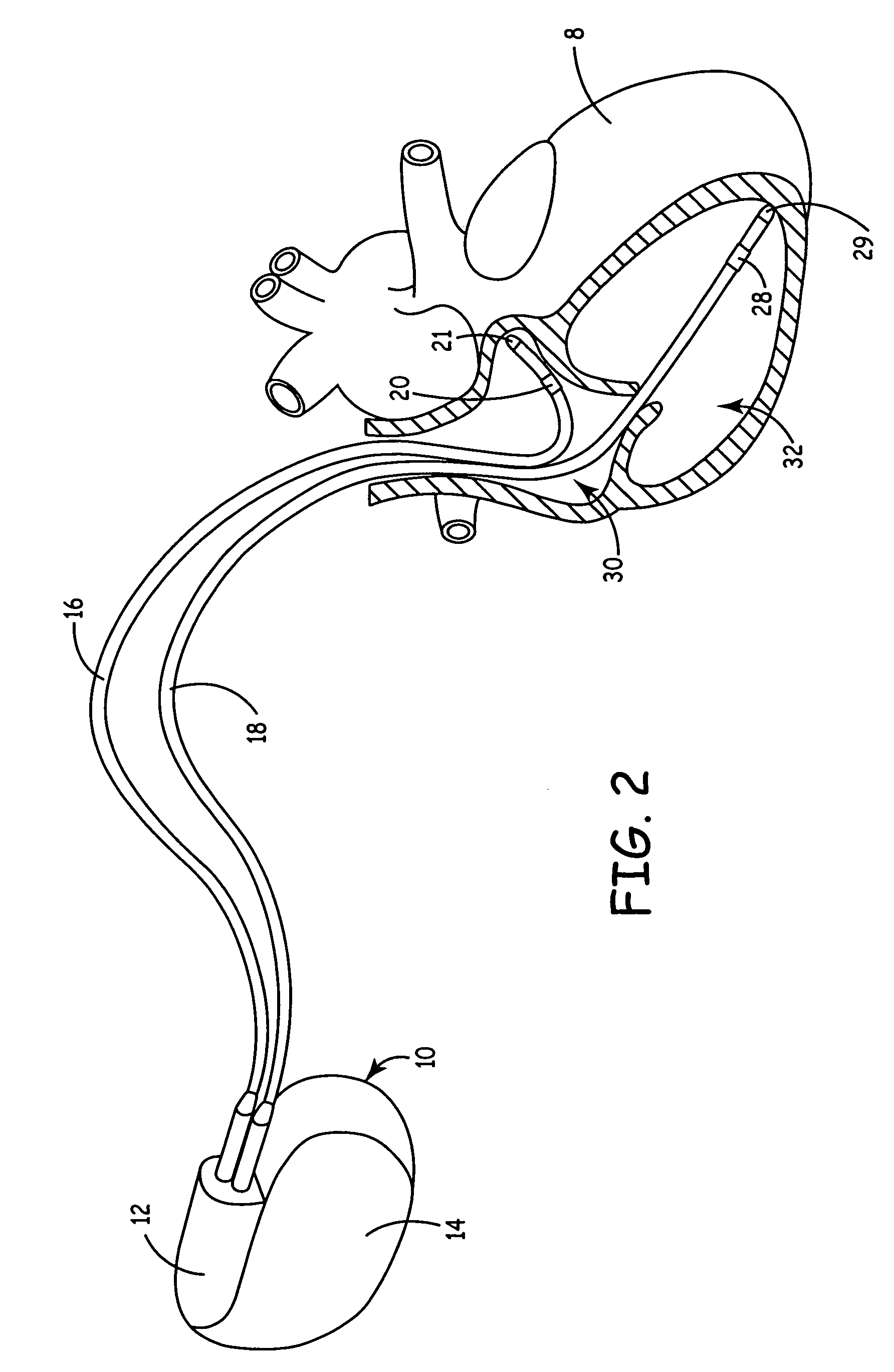 Implantable medical device with ventricular pacing protocol including progressive conduction search