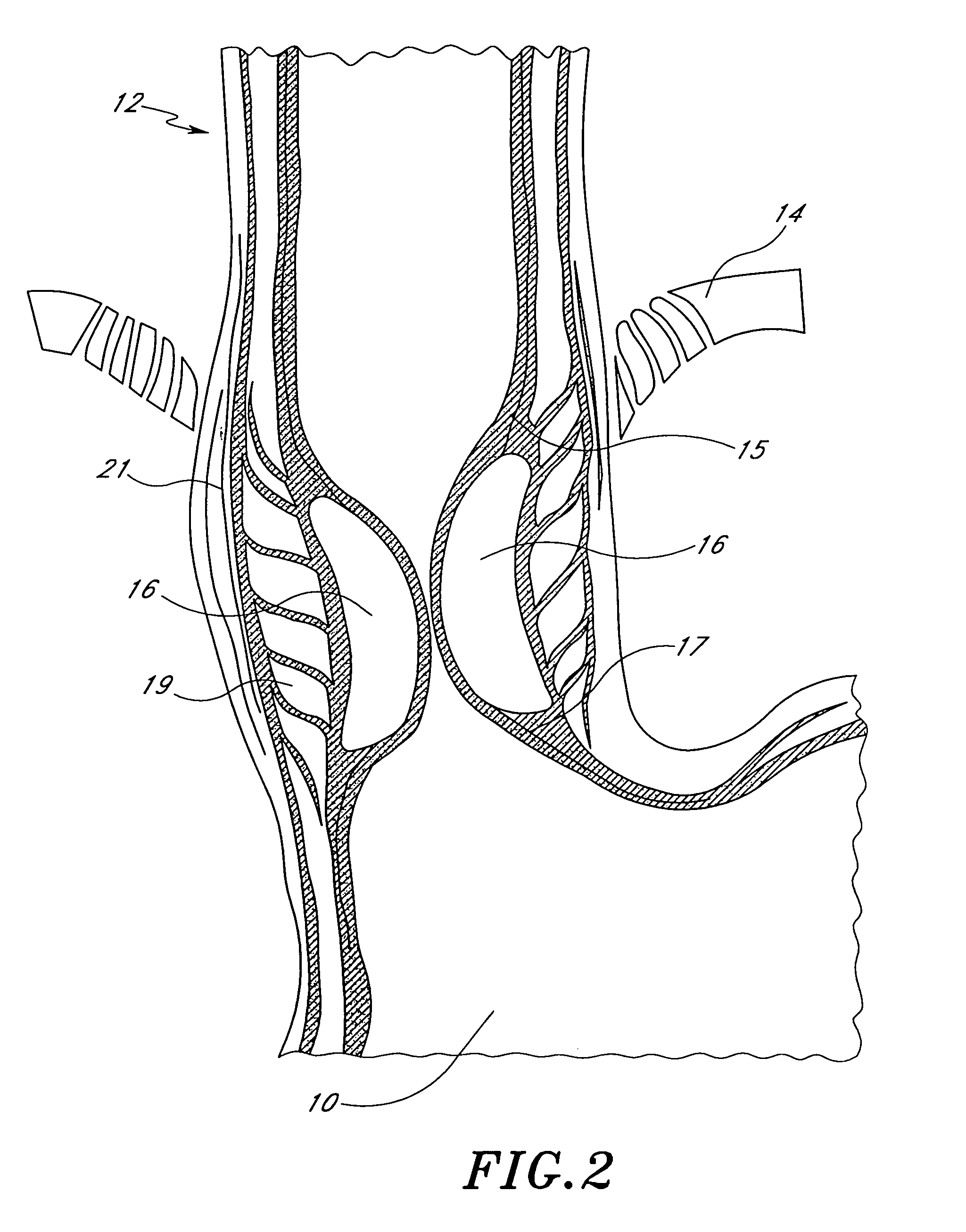 Method and device for treating gastroesophageal reflux disease