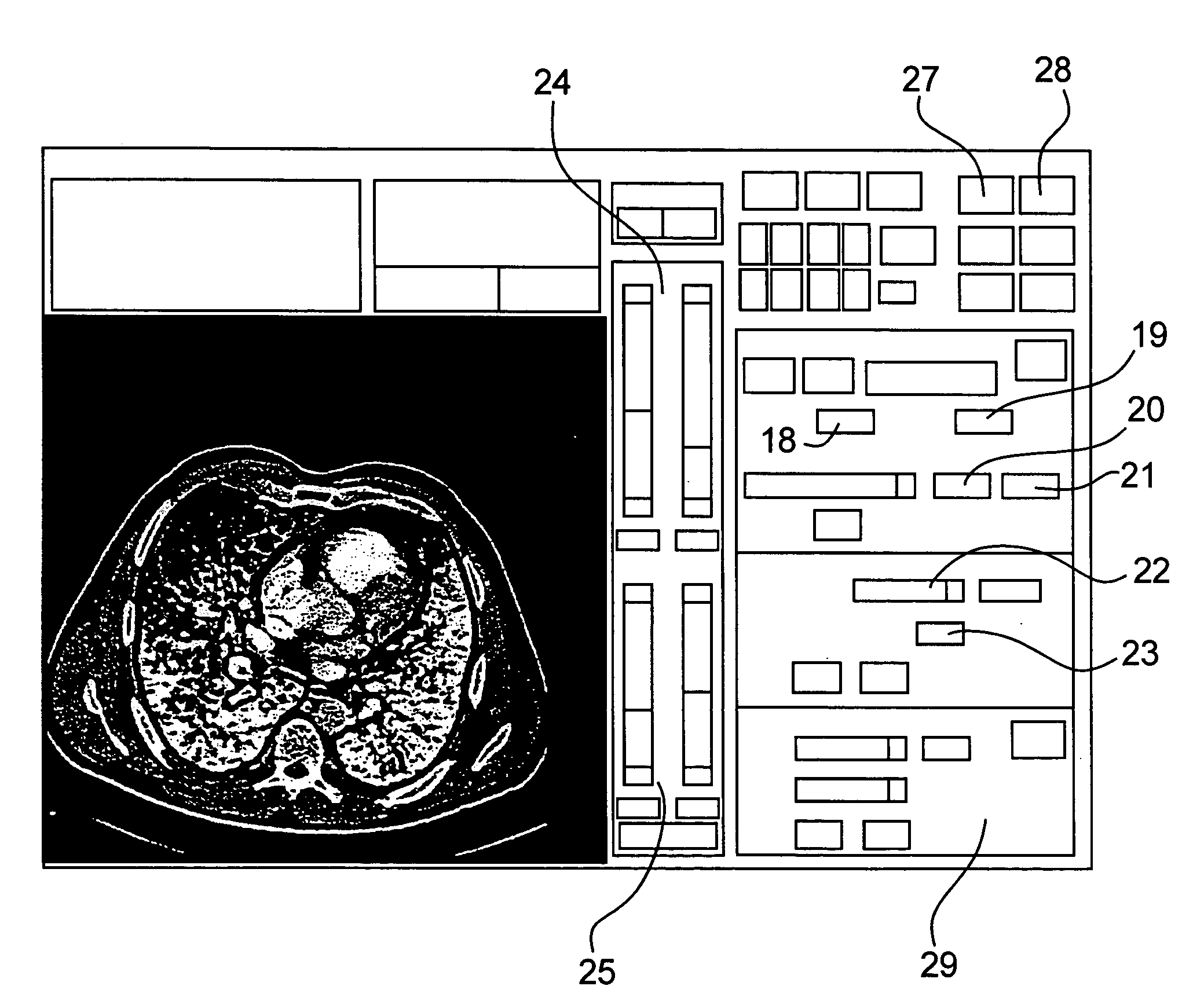 Method and apparatus for processing a computed tomography image of a lung obtained using contrast agent