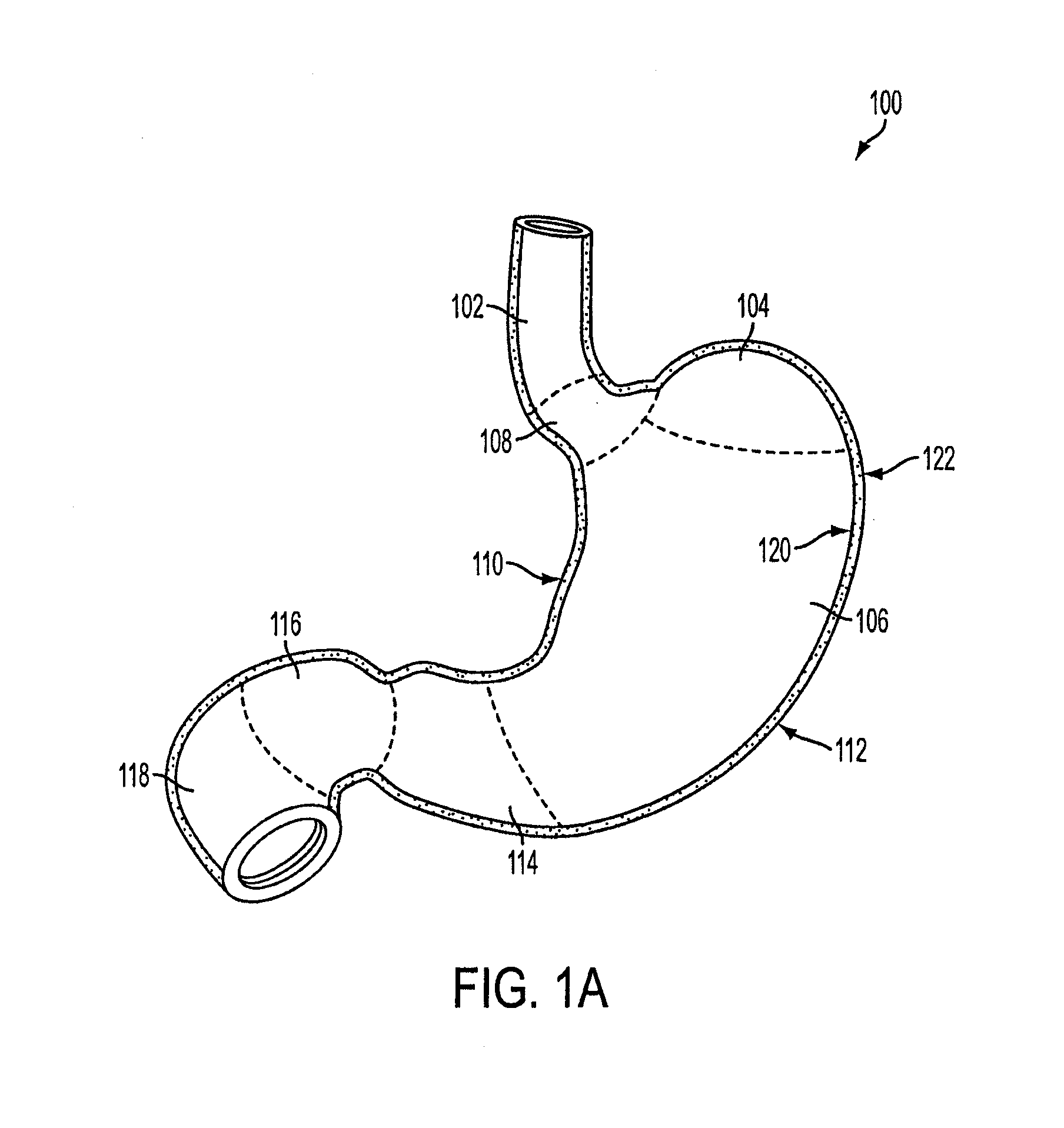 Gastric restriction devices for treating obesity