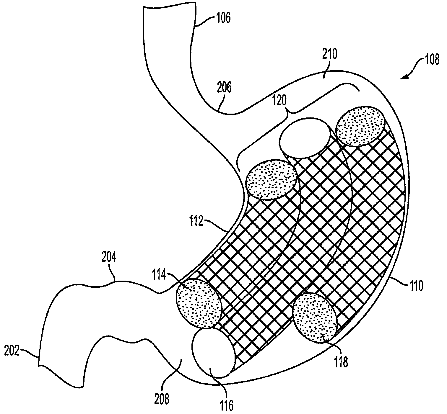 Method and apparatus for treating obesity and controlling weight gain using adjustable intragastric devices