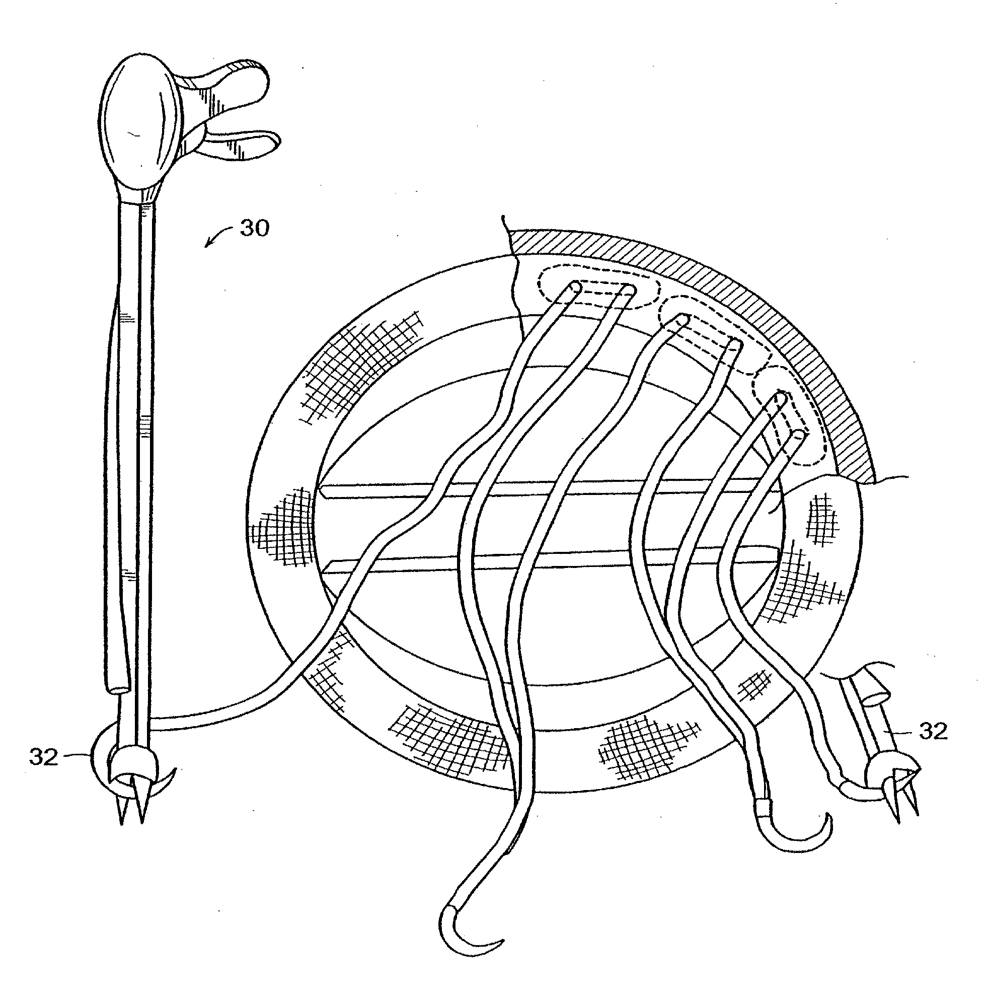 Suture system