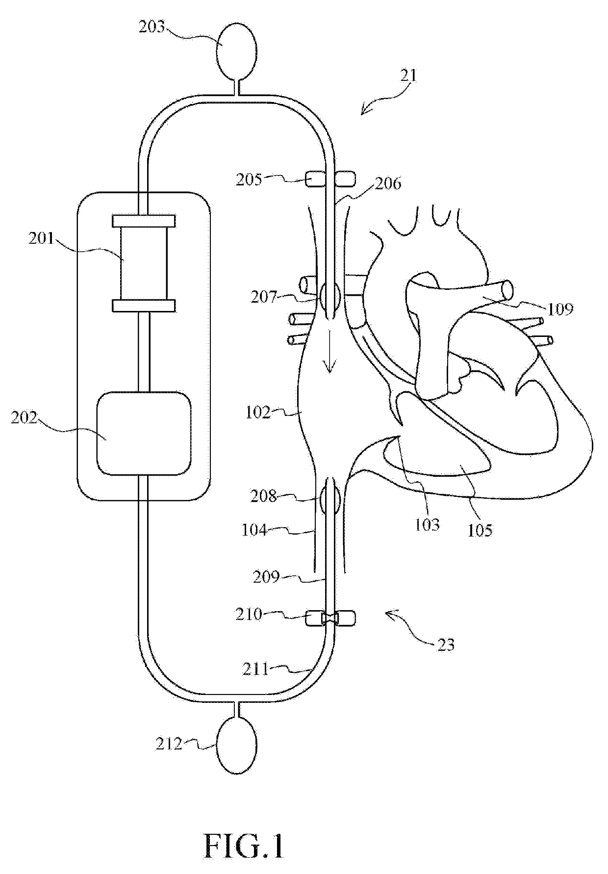 Extracorporeal life support system