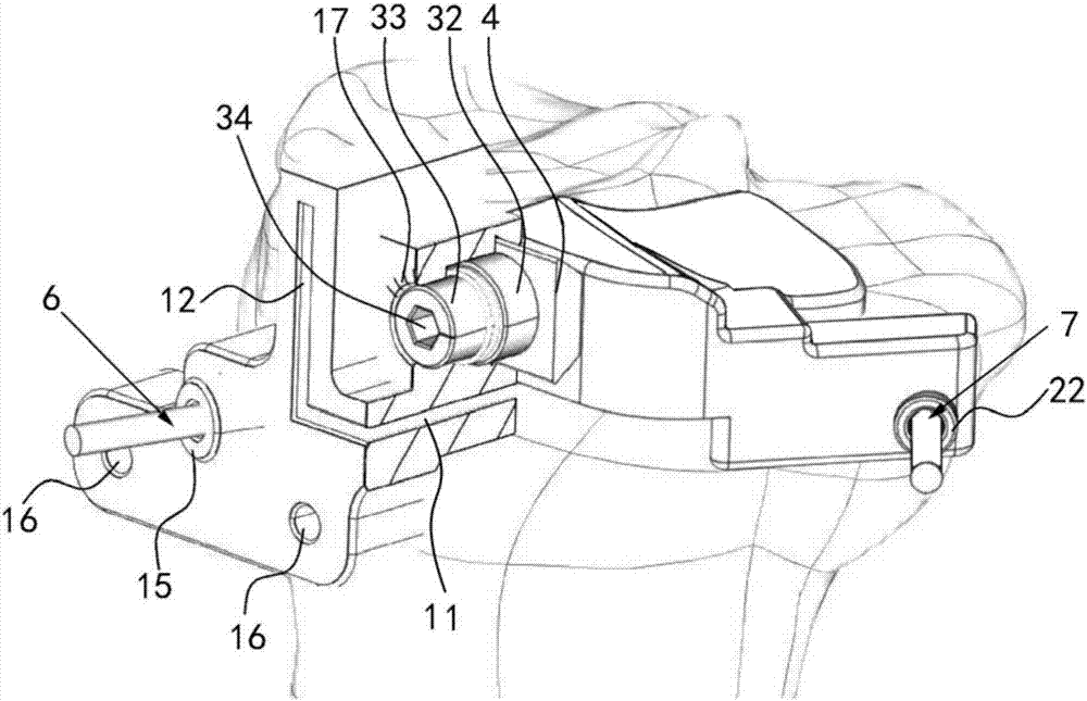 Tibia unicompartmental osteotomy device