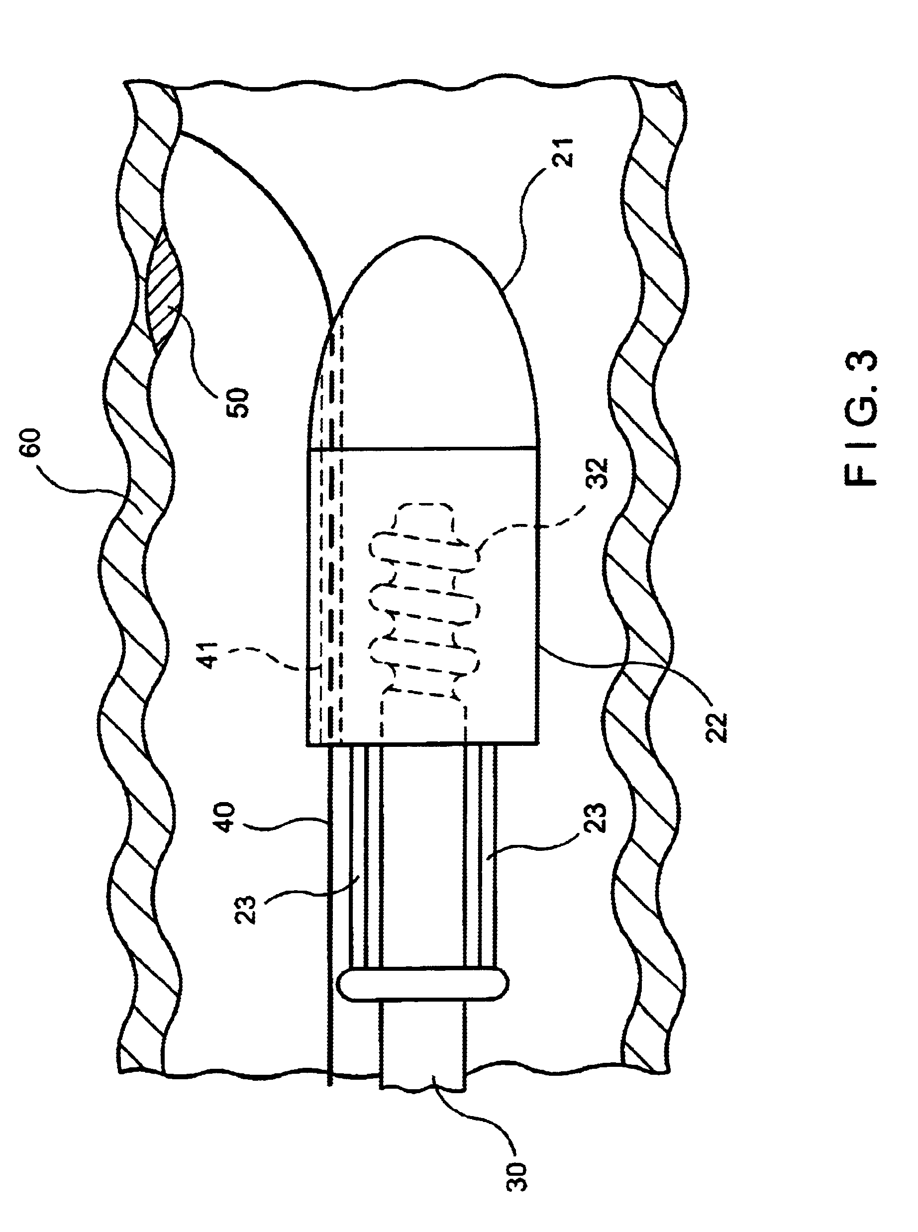 Endoscopic resection devices