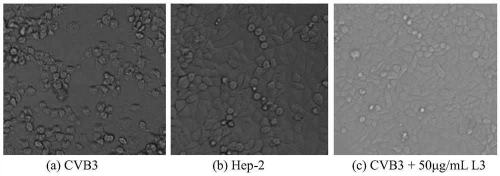 Application of Monoiodoaromatic Acids as CVB3 Virus Inhibitors