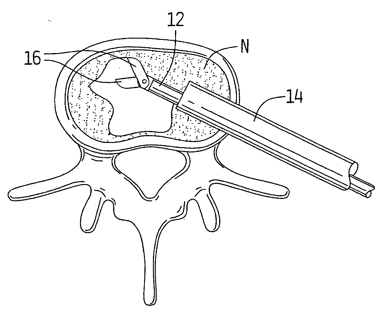 Spinal implant and method of use