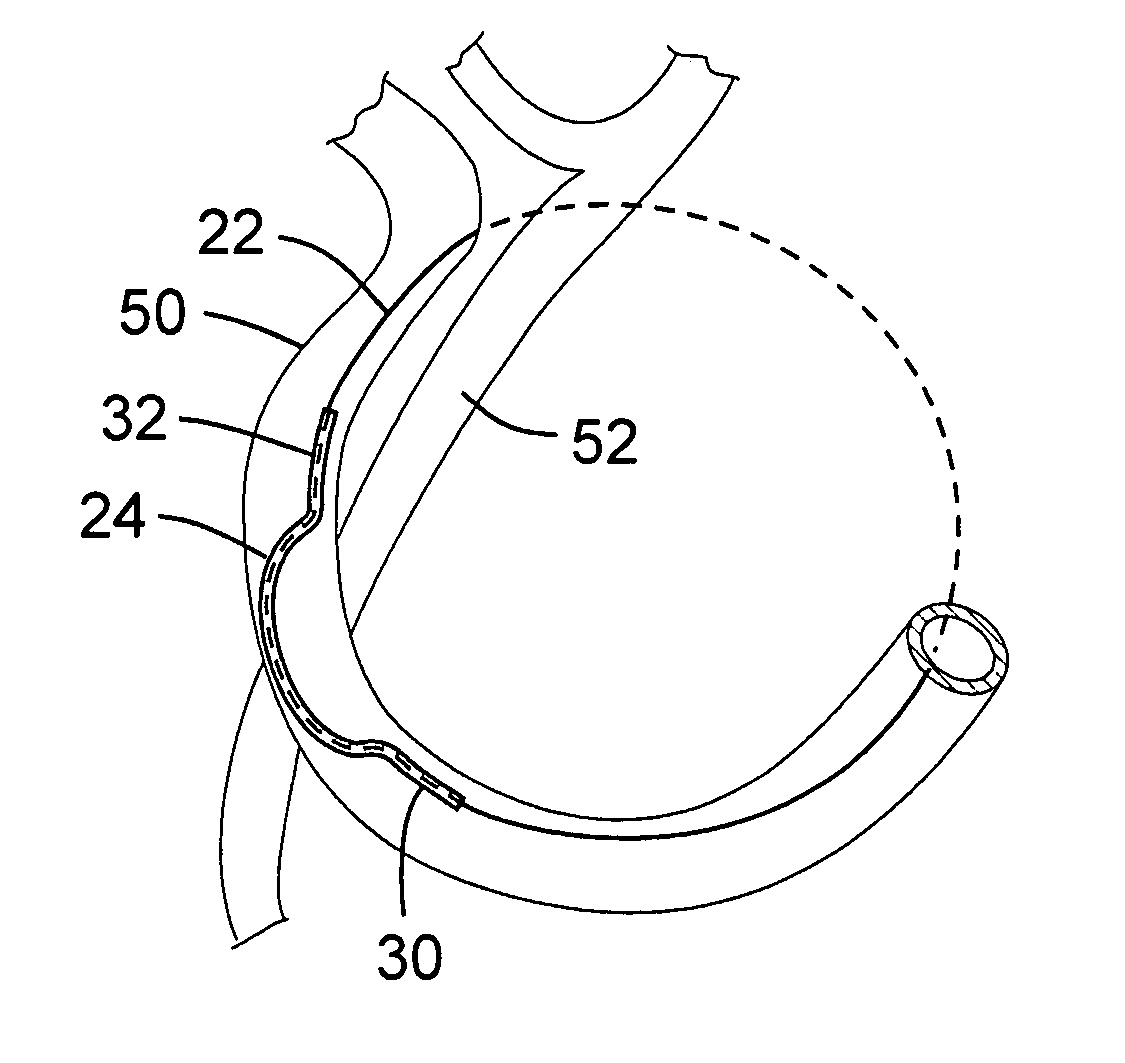 Transcatheter coronary sinus mitral valve annuloplasty procedure and coronary artery and myocardial protection device