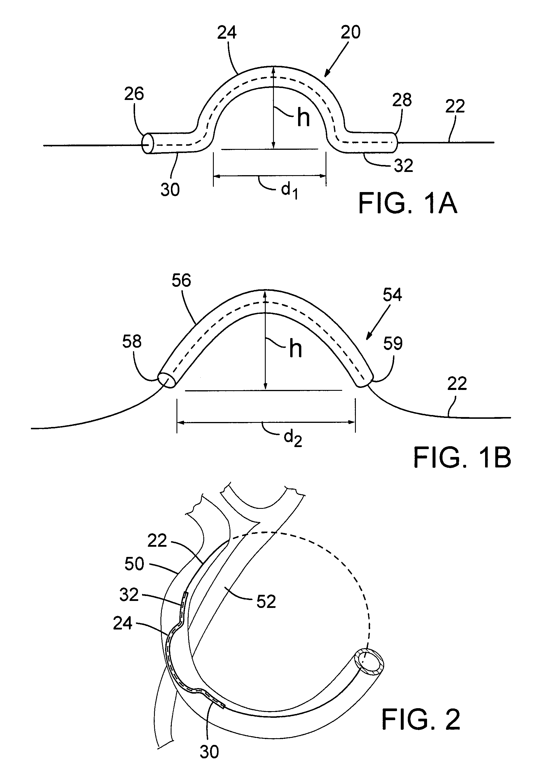 Transcatheter coronary sinus mitral valve annuloplasty procedure and coronary artery and myocardial protection device