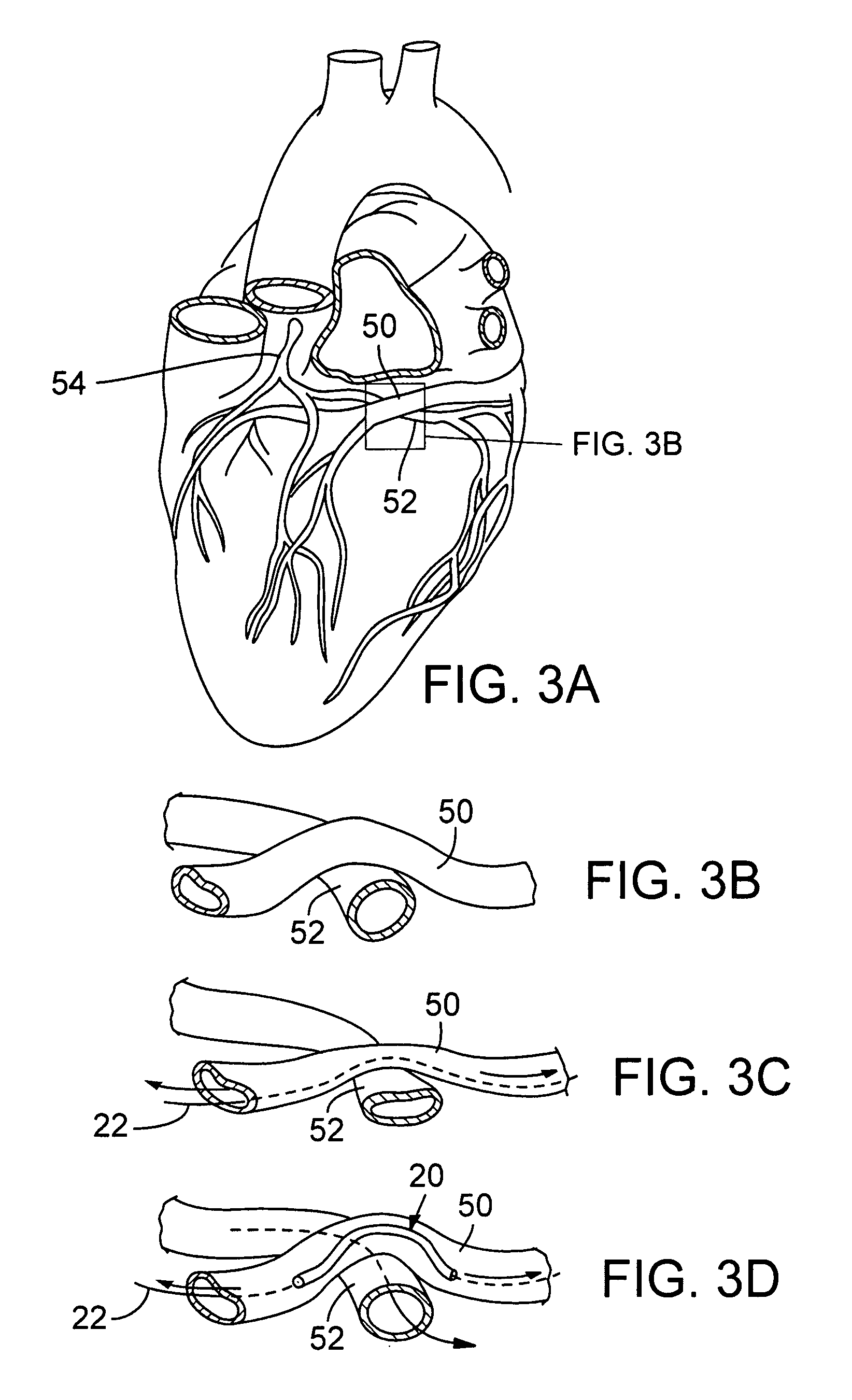 Transcatheter coronary sinus mitral valve annuloplasty procedure and coronary artery and myocardial protection device