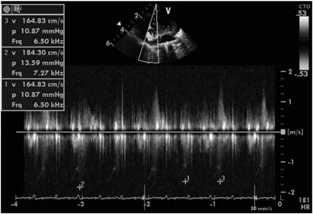 Molding method of rhesus monkey pulmonary fibrosis model, preparation, preparation method of preparation, rhesus monkey pulmonary fibrosis model and application thereof