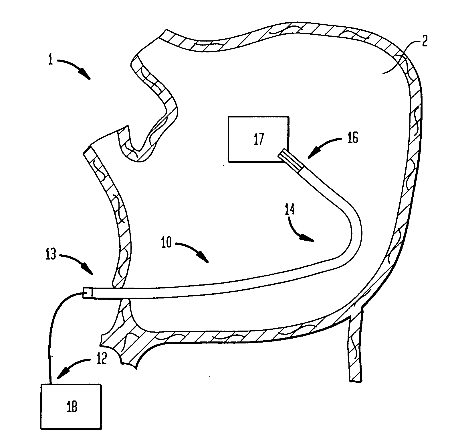 Steerable catheter