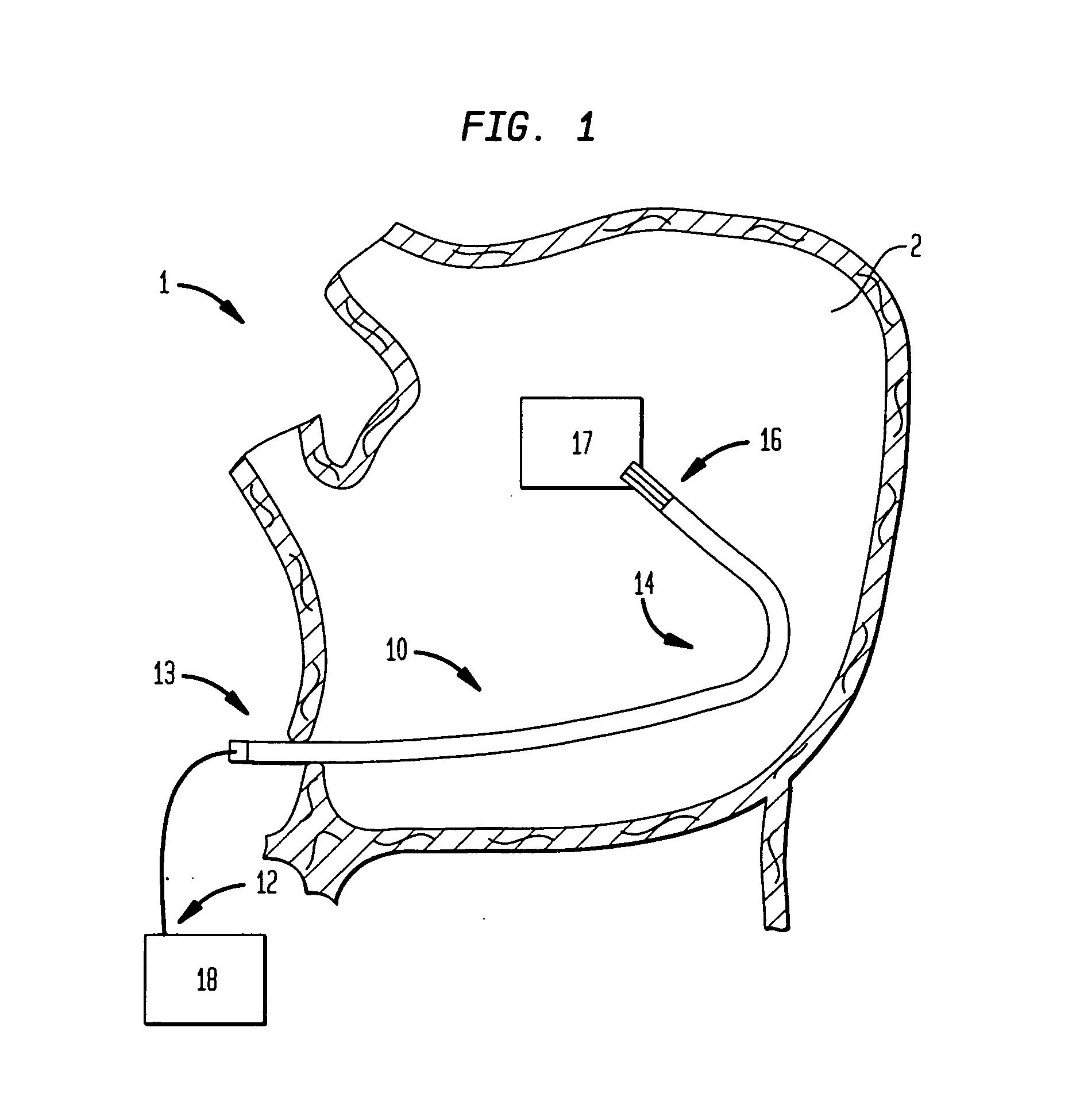 Steerable catheter