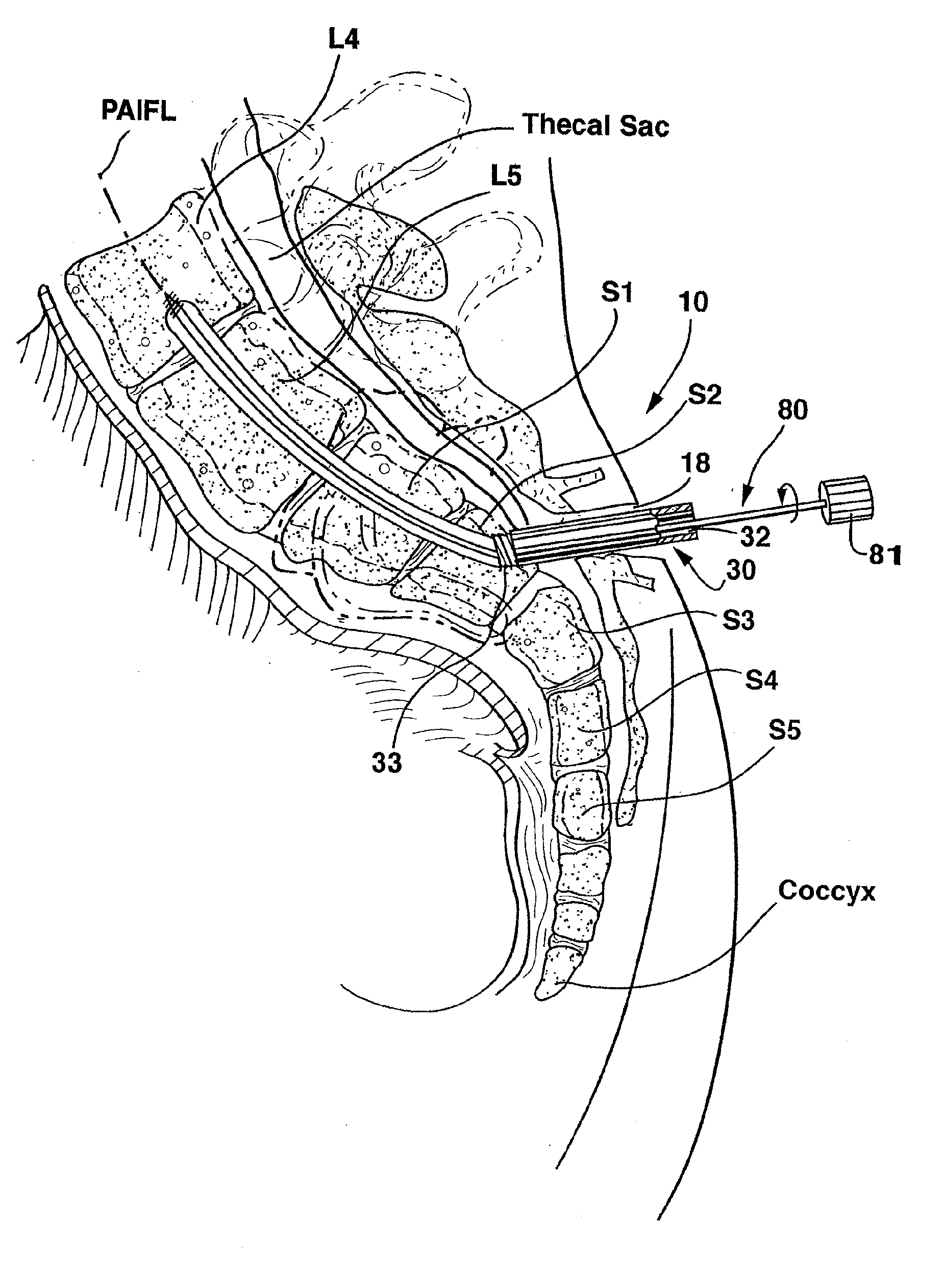 Method and apparatus for providing access to a presacral space