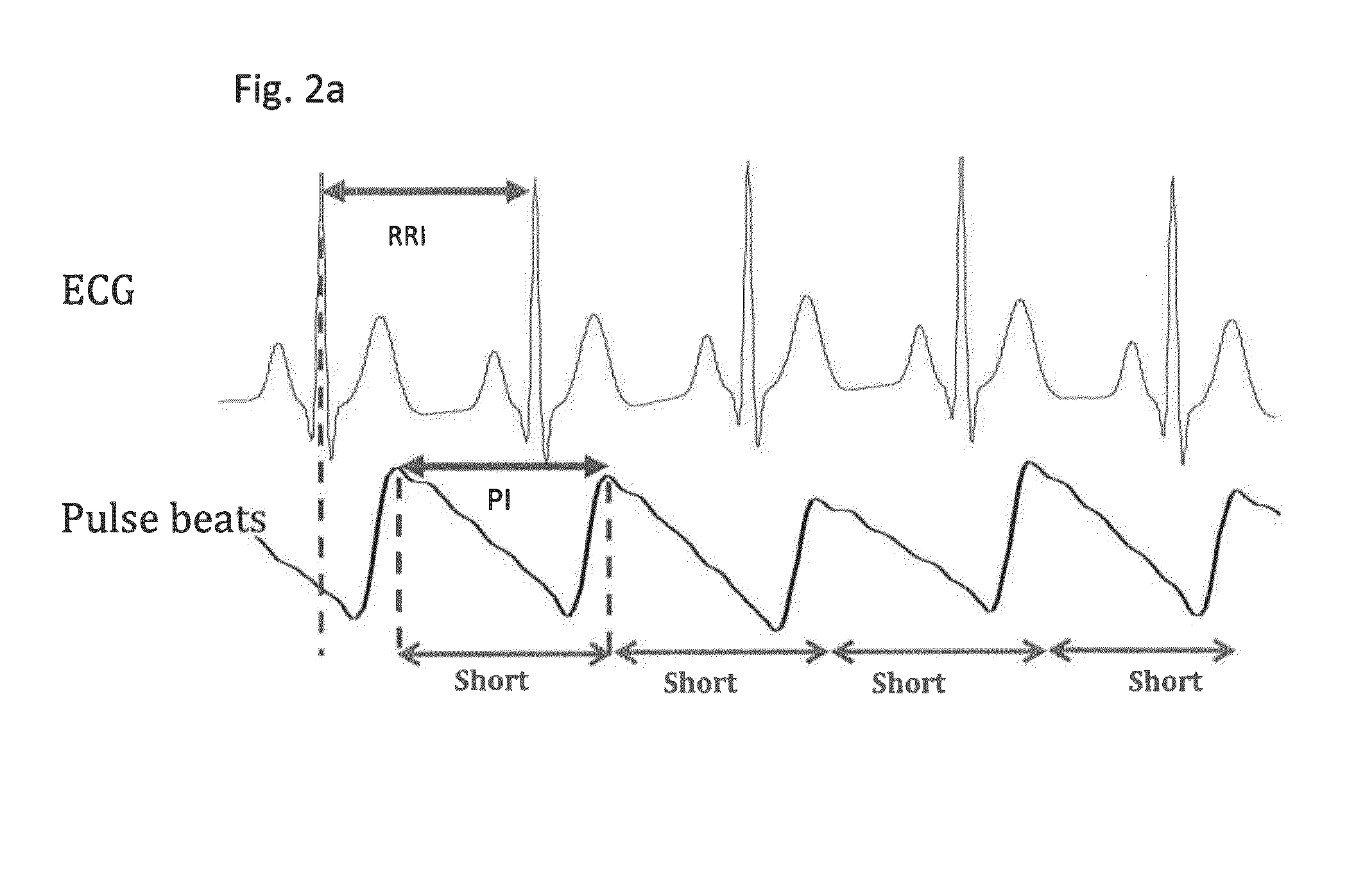 Detection and monitoring of atrial fibrillation