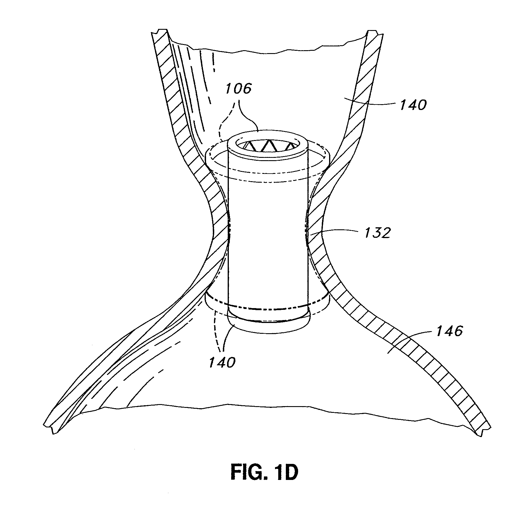 Adjustable prosthetic valve implant