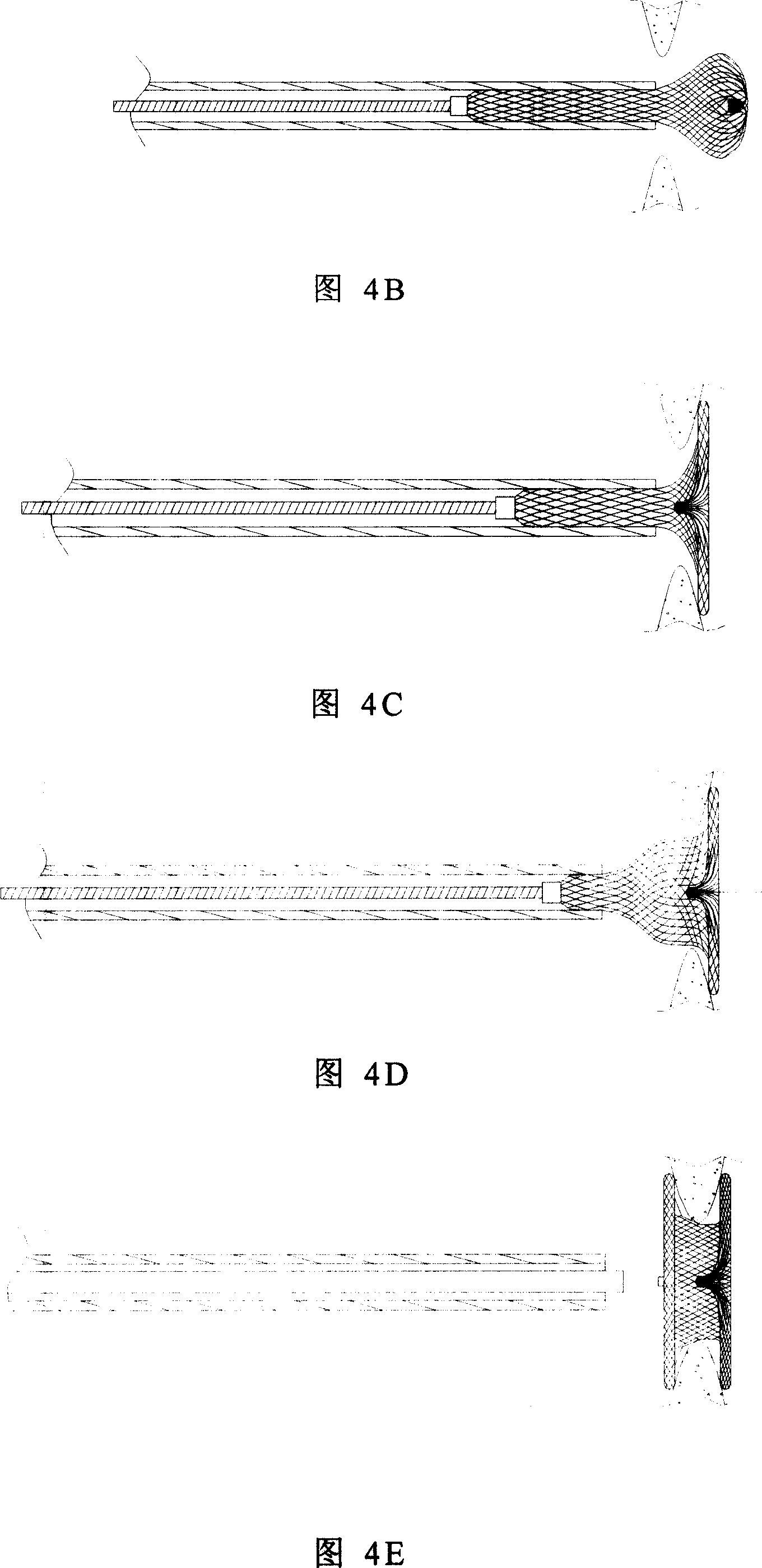 Heart septal defect blocking device