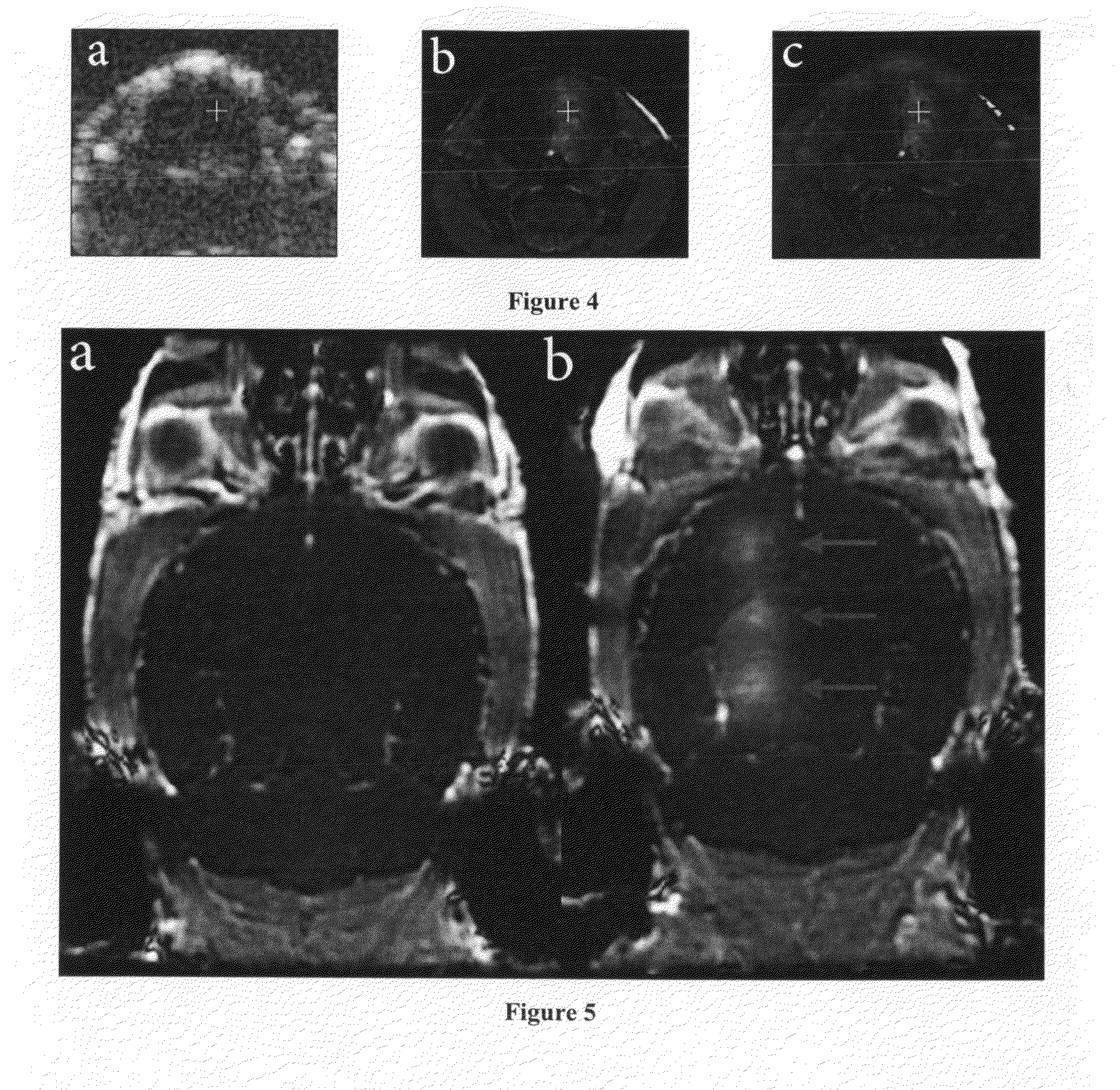 Method and apparatus for delivery of agents across the blood brain barrier