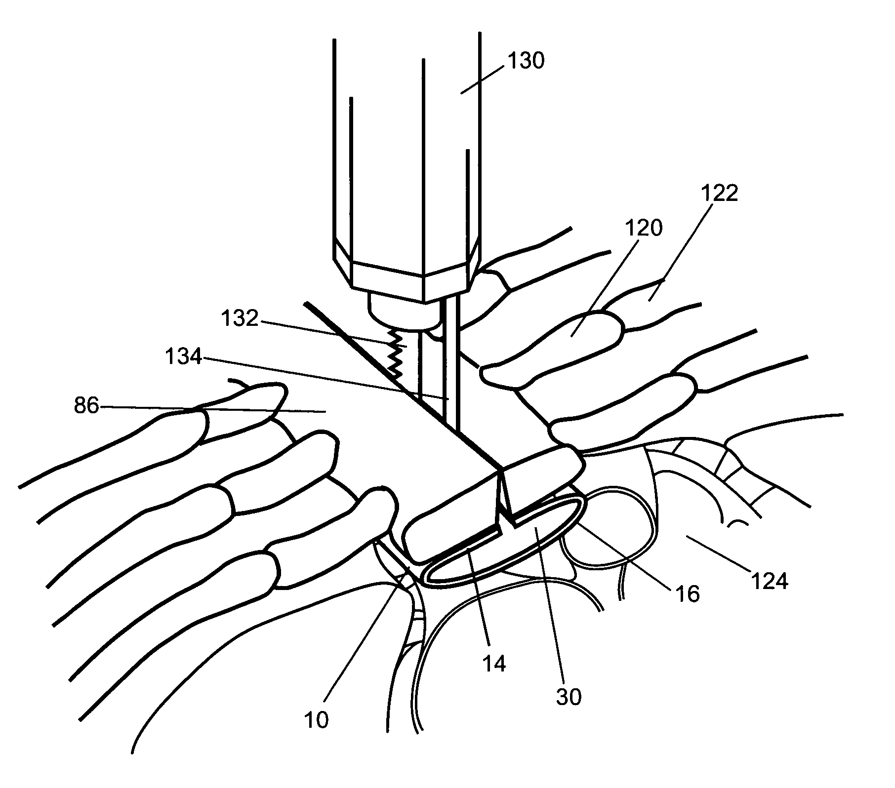 Anti-adhesion device