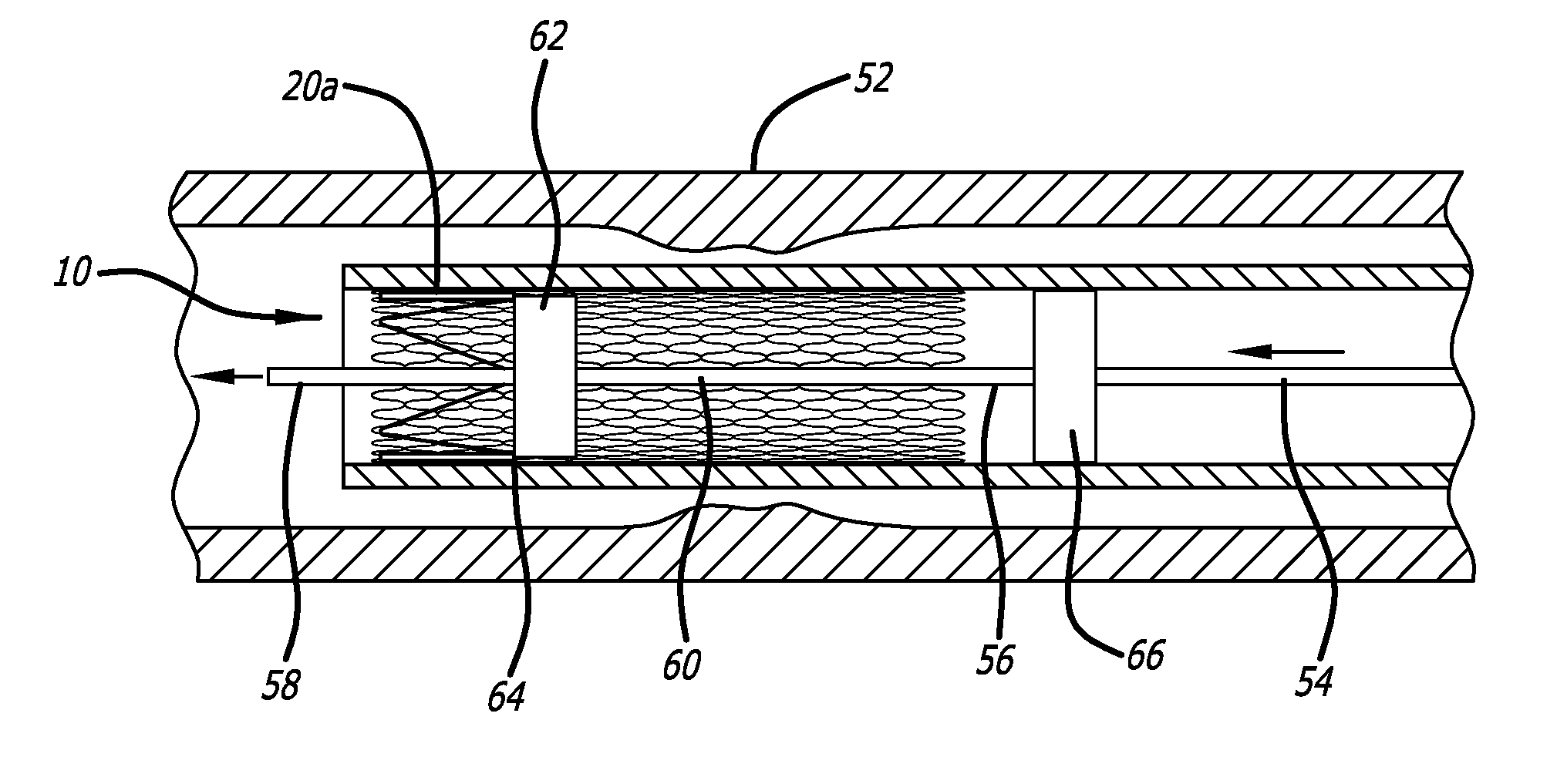 Braided stent with expansion ring and method of delivery