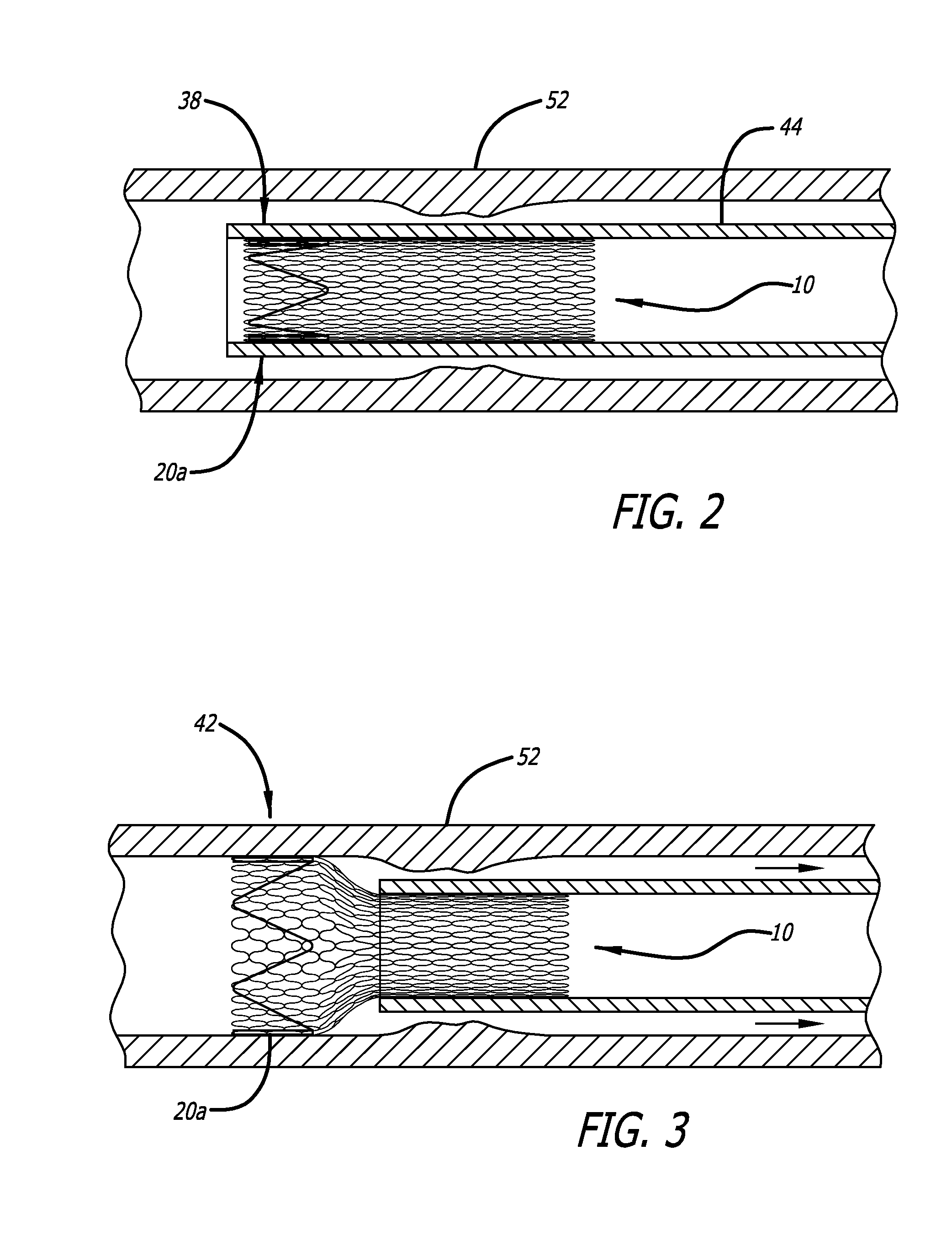 Braided stent with expansion ring and method of delivery