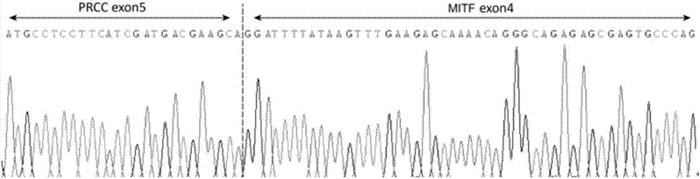 Separating probe combination for diagnosing MITF (Microphthalmia-associated Transcription Factor) translocation kidney cancer and application of separating probe combination