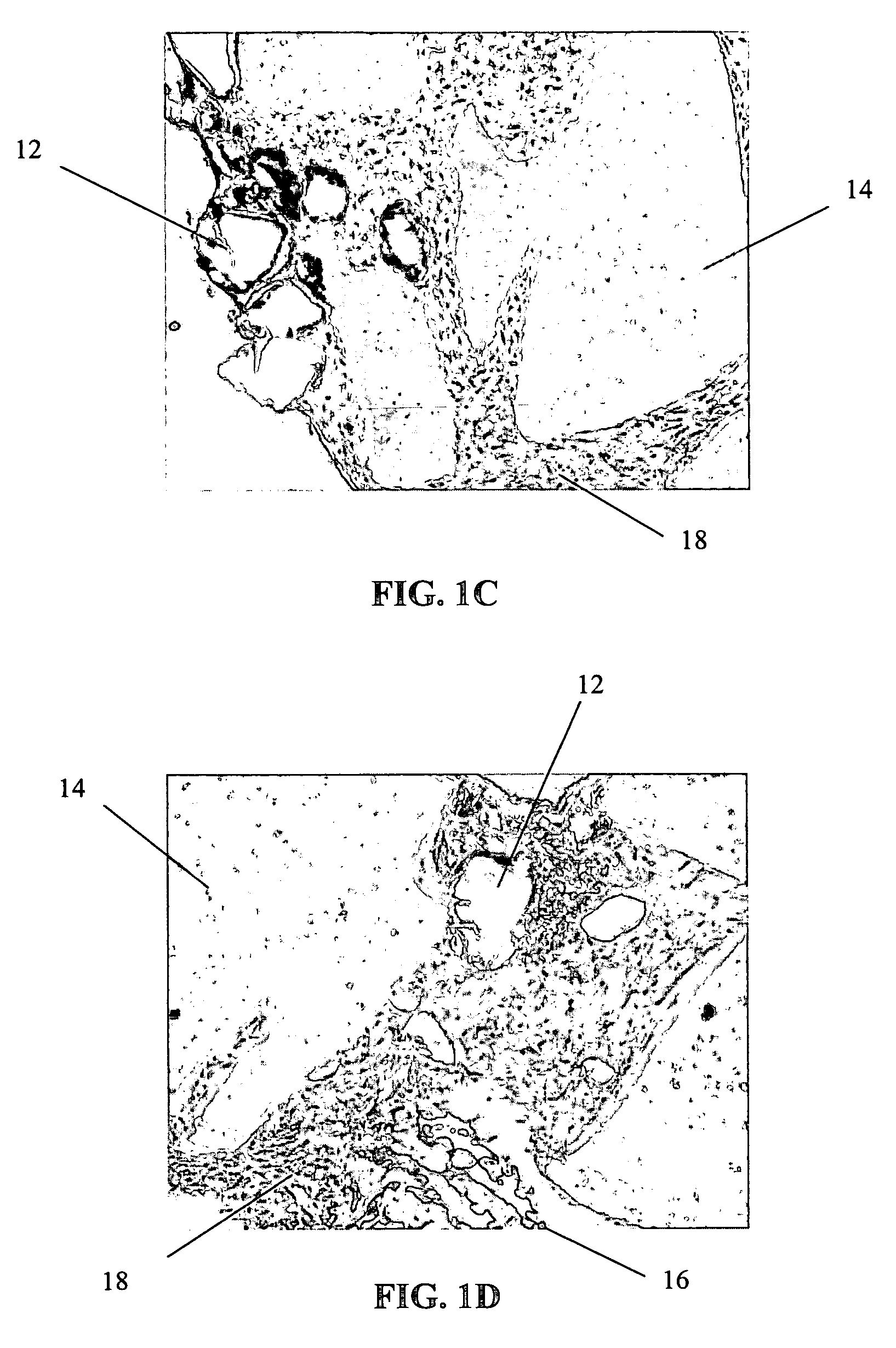 Conformable tissue repair implant capable of injection delivery