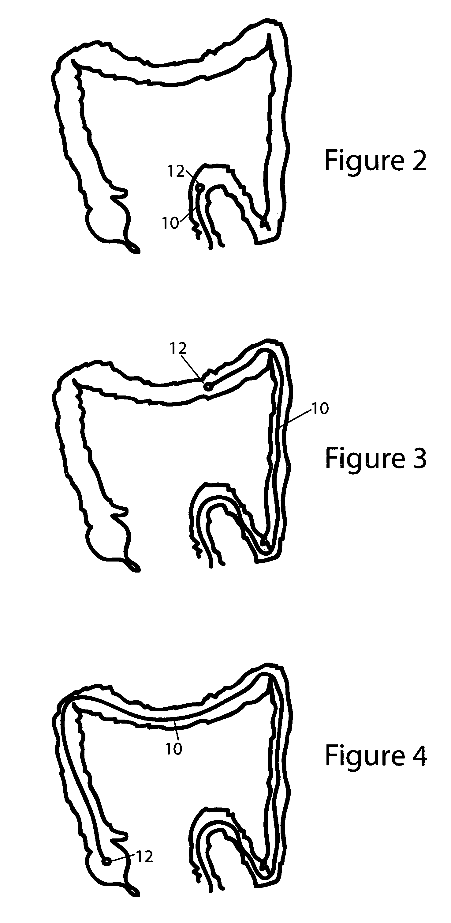 Magnetically guided colonoscope