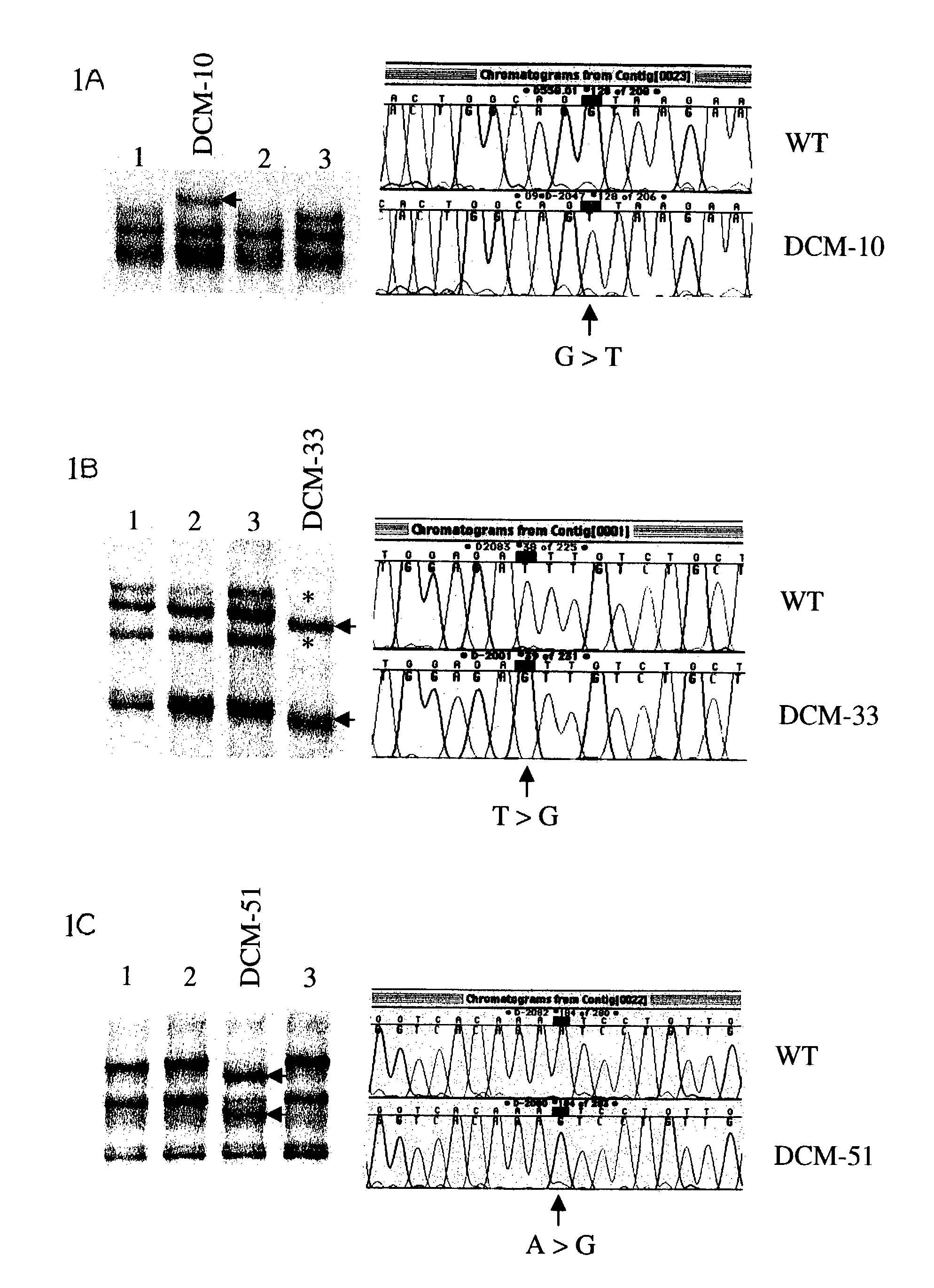 Alterations in the dystrophin gene associated with sporadic dilated cardiomyopathy