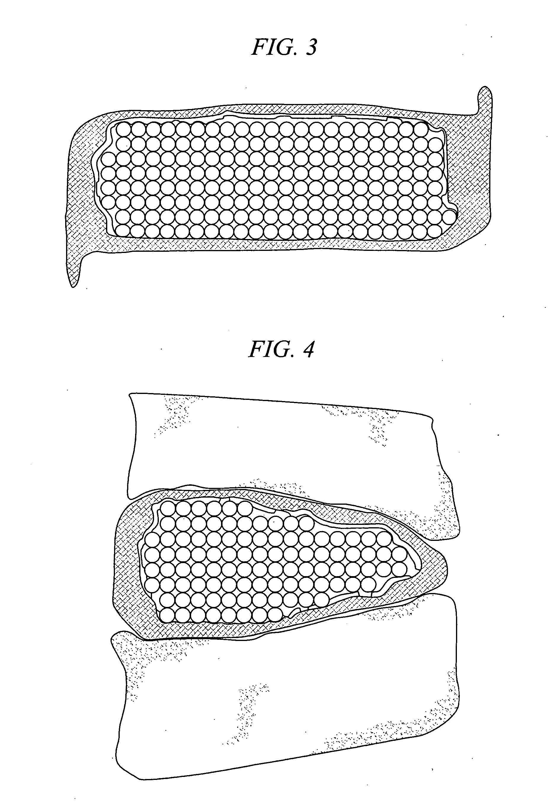 Prostheses for spine discs having fusion capability