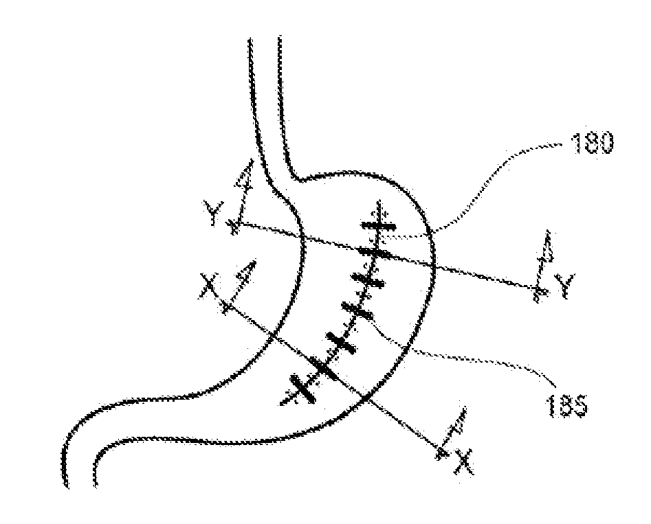 Devices and systems for manipulating tissue