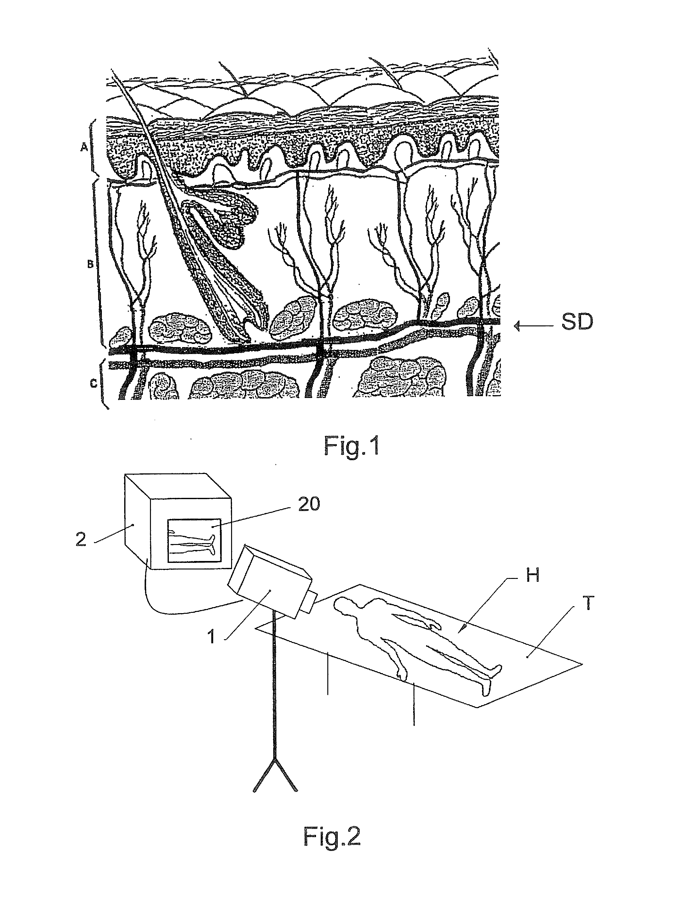 Method and control system for a treatment by subcutaneous or intracutaneous irradiation by means of electromagnetic radiation