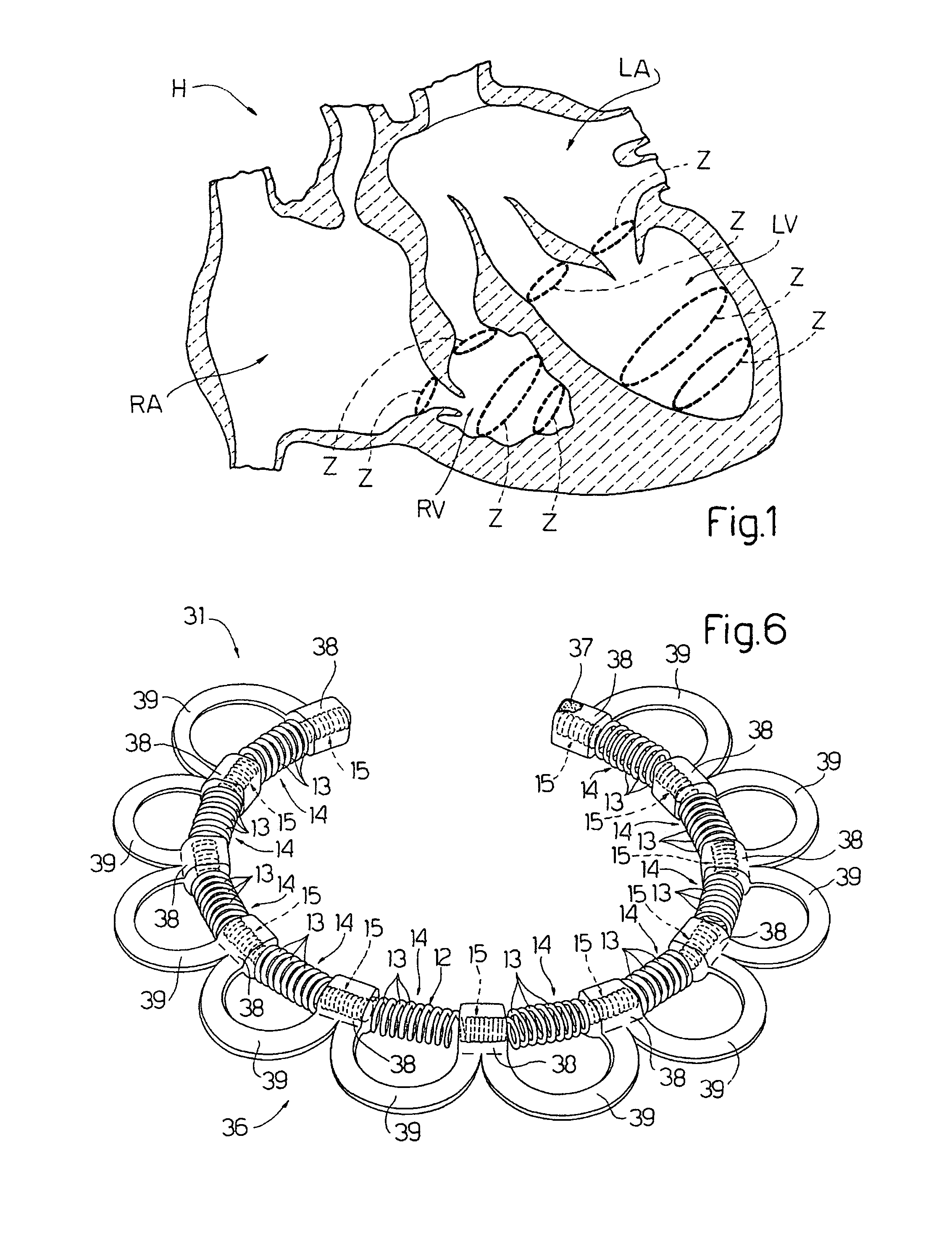 Intracardiac device for restoring the functional elasticity of the cardiac structures, holding tool for the intracardiac device, and method for implantation of the intracardiac device in the heart