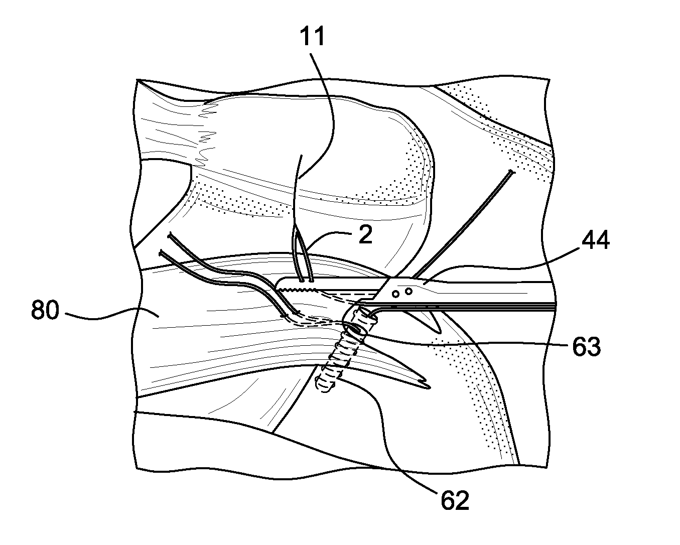 Suturing construct with spliced tails