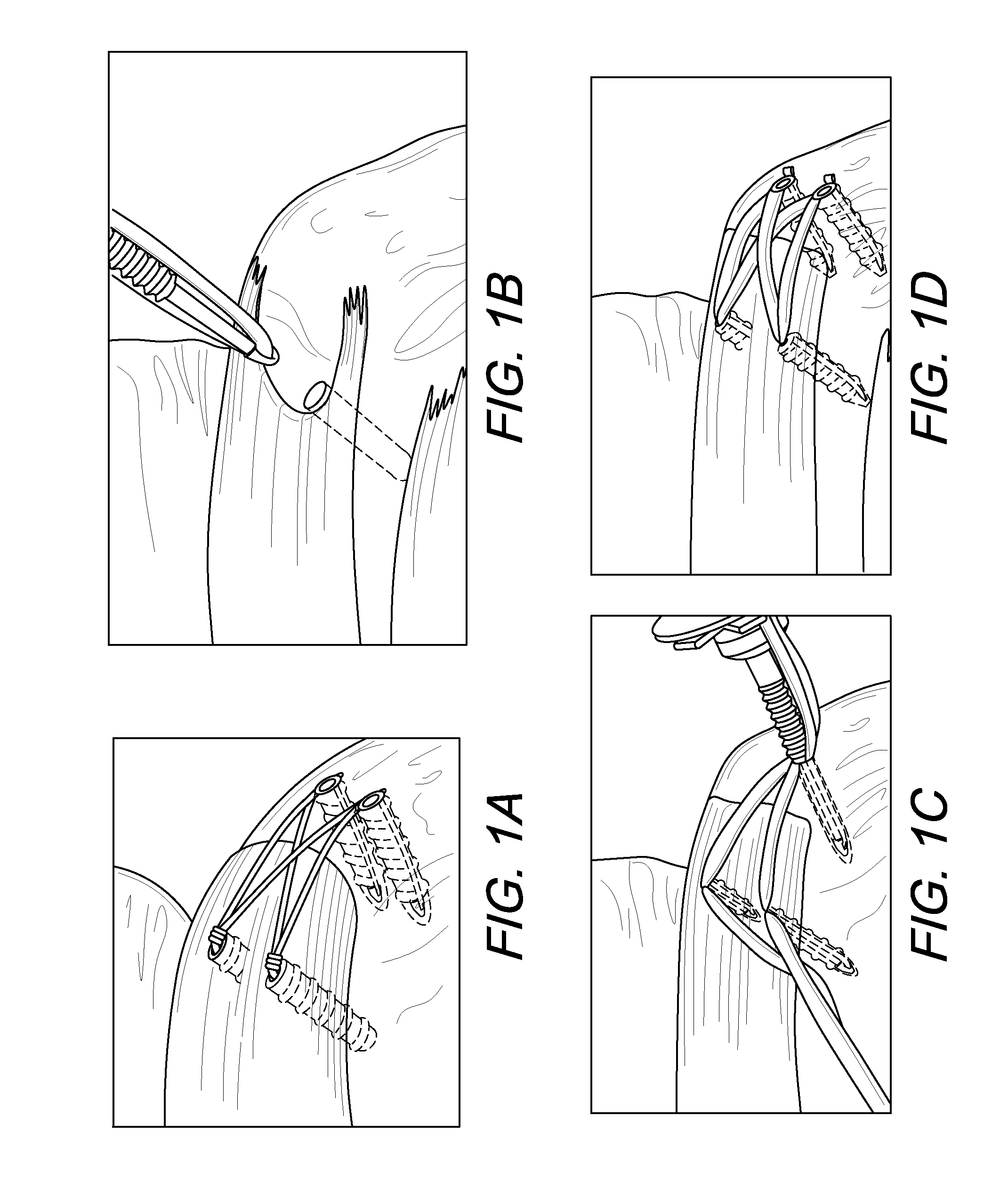 Suturing construct with spliced tails