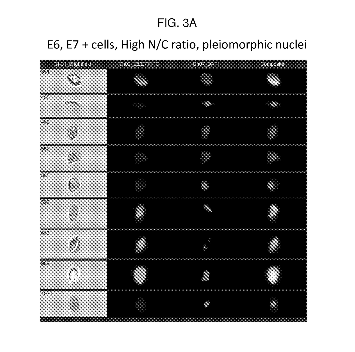 Methods and Systems for Predicting Whether a Subject Has a Cervical Intraepithelial Neoplasia (CIN) Lesion from a Suspension Sample of Cervical Cells