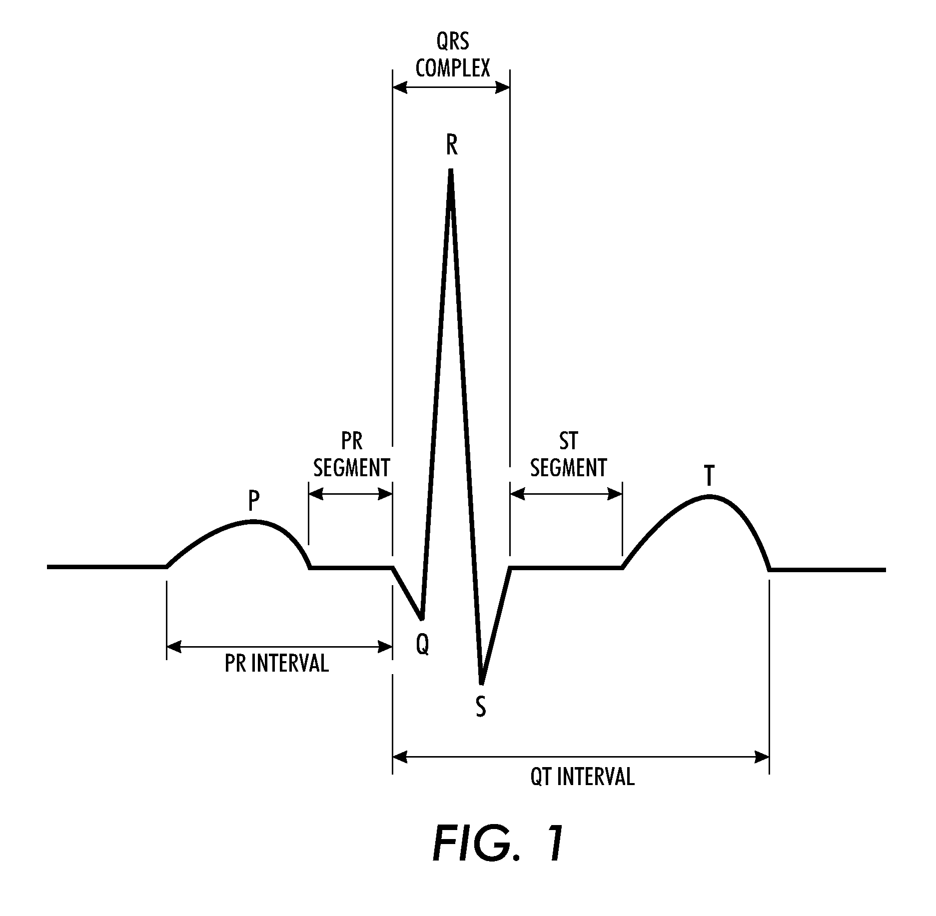 Determining cardiac arrhythmia from a video of a subject being monitored for cardiac function