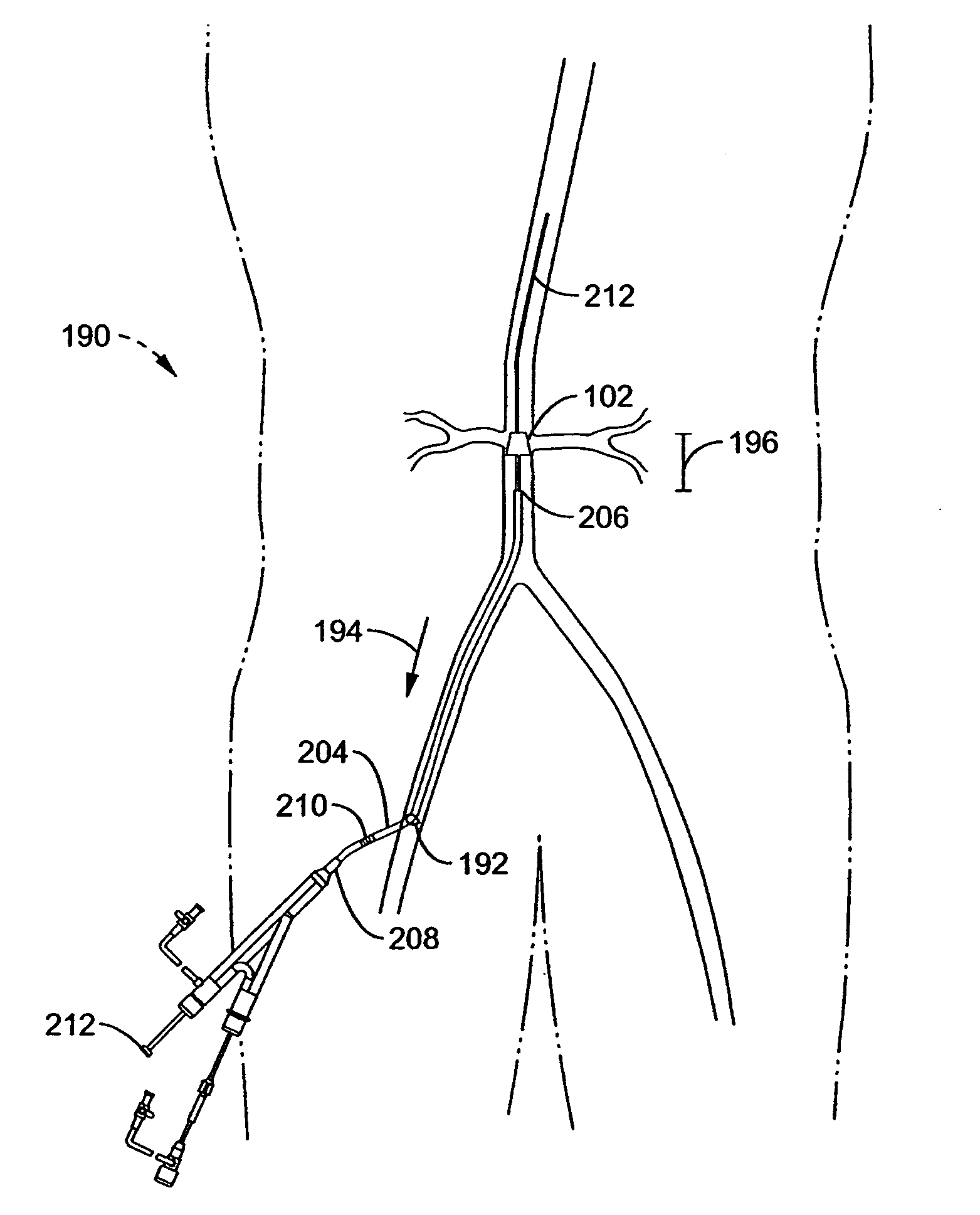 Apparatus and method for inserting an intra-aorta catheter through a delivery sheath