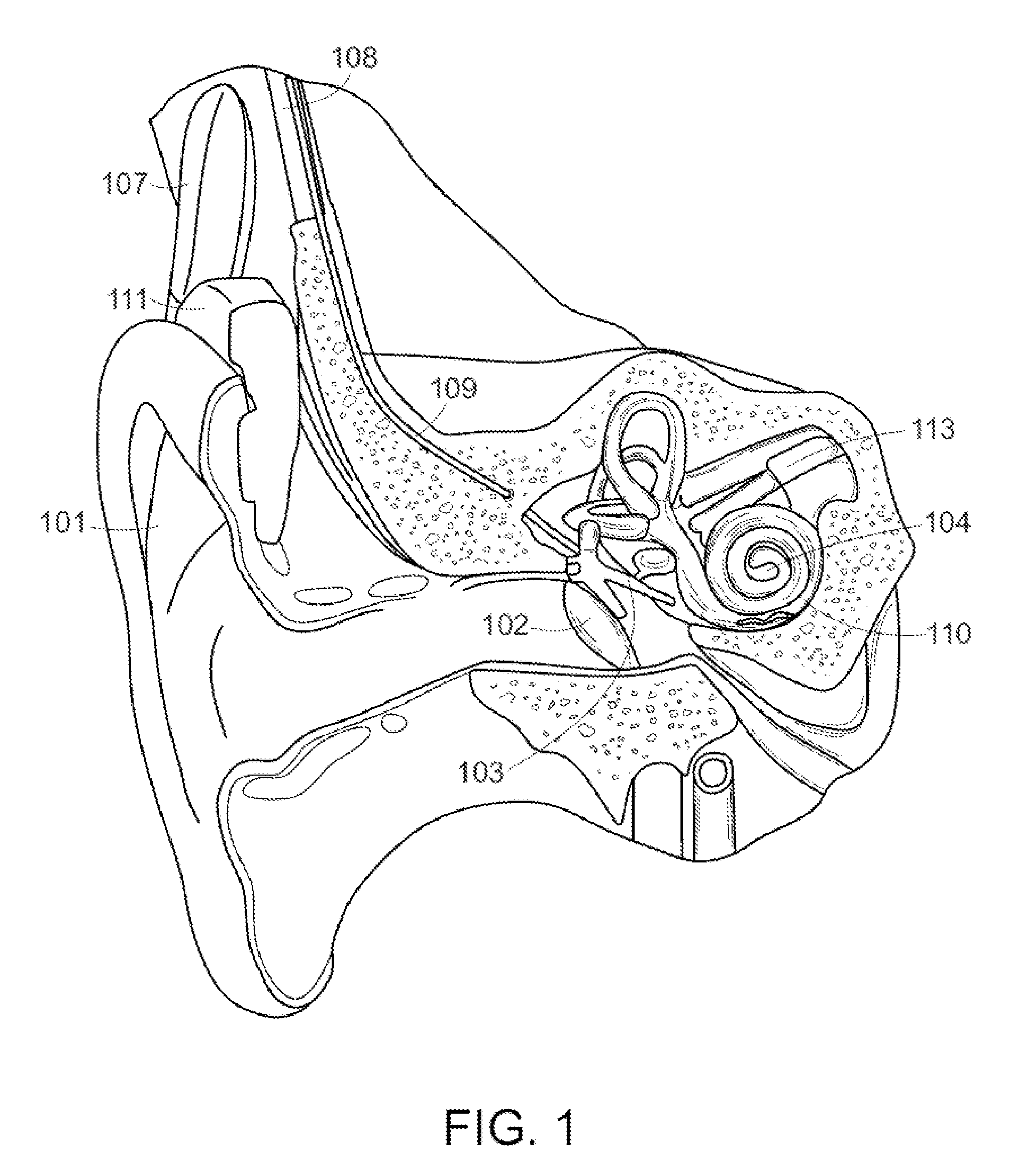 MRI Safe Actuator for Implantable Floating Mass Transducer