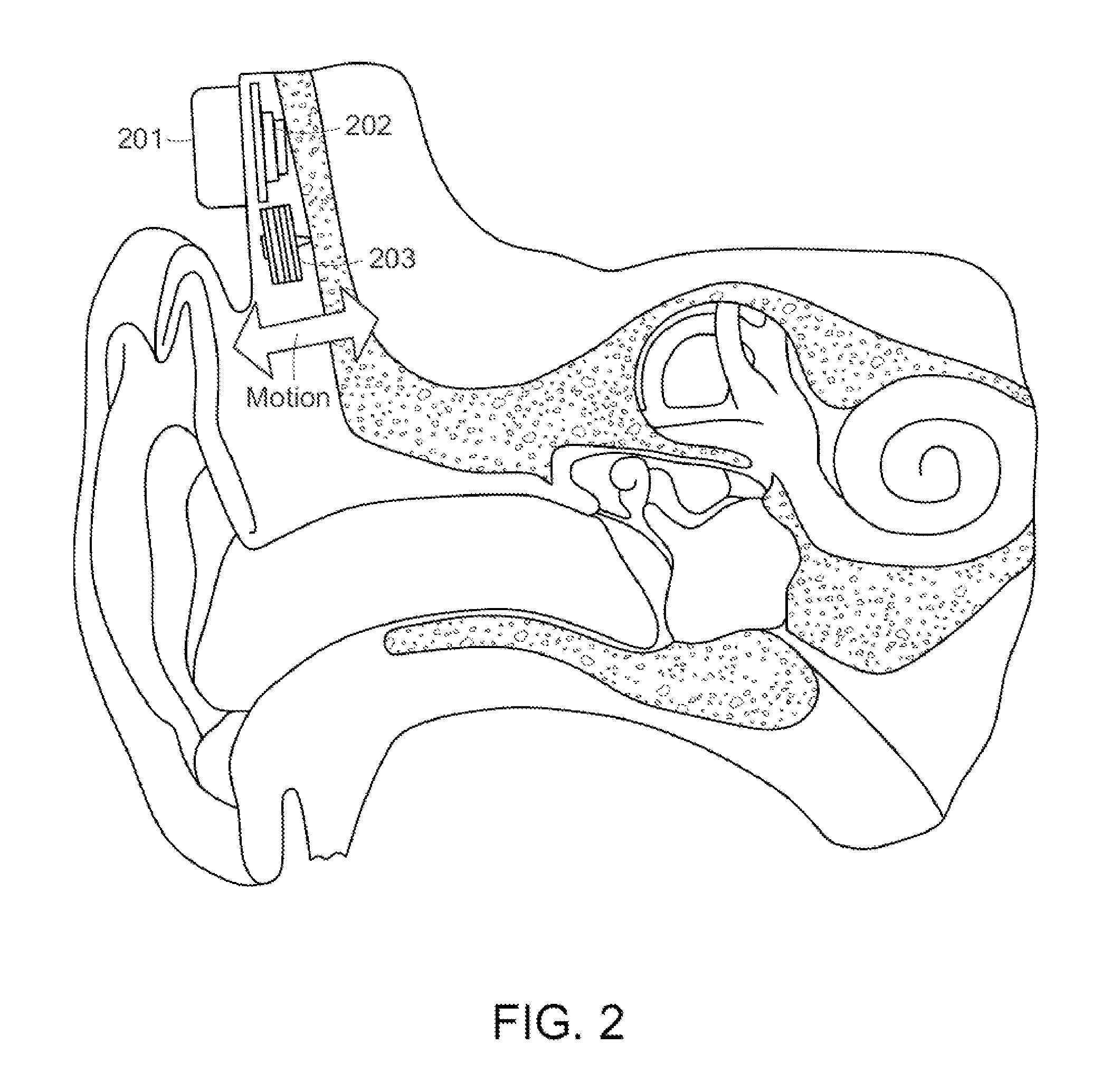 MRI Safe Actuator for Implantable Floating Mass Transducer