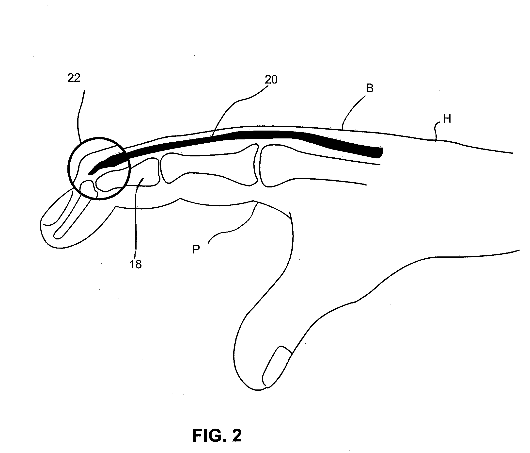 Goalkeeper's glove with protective fingertip extension