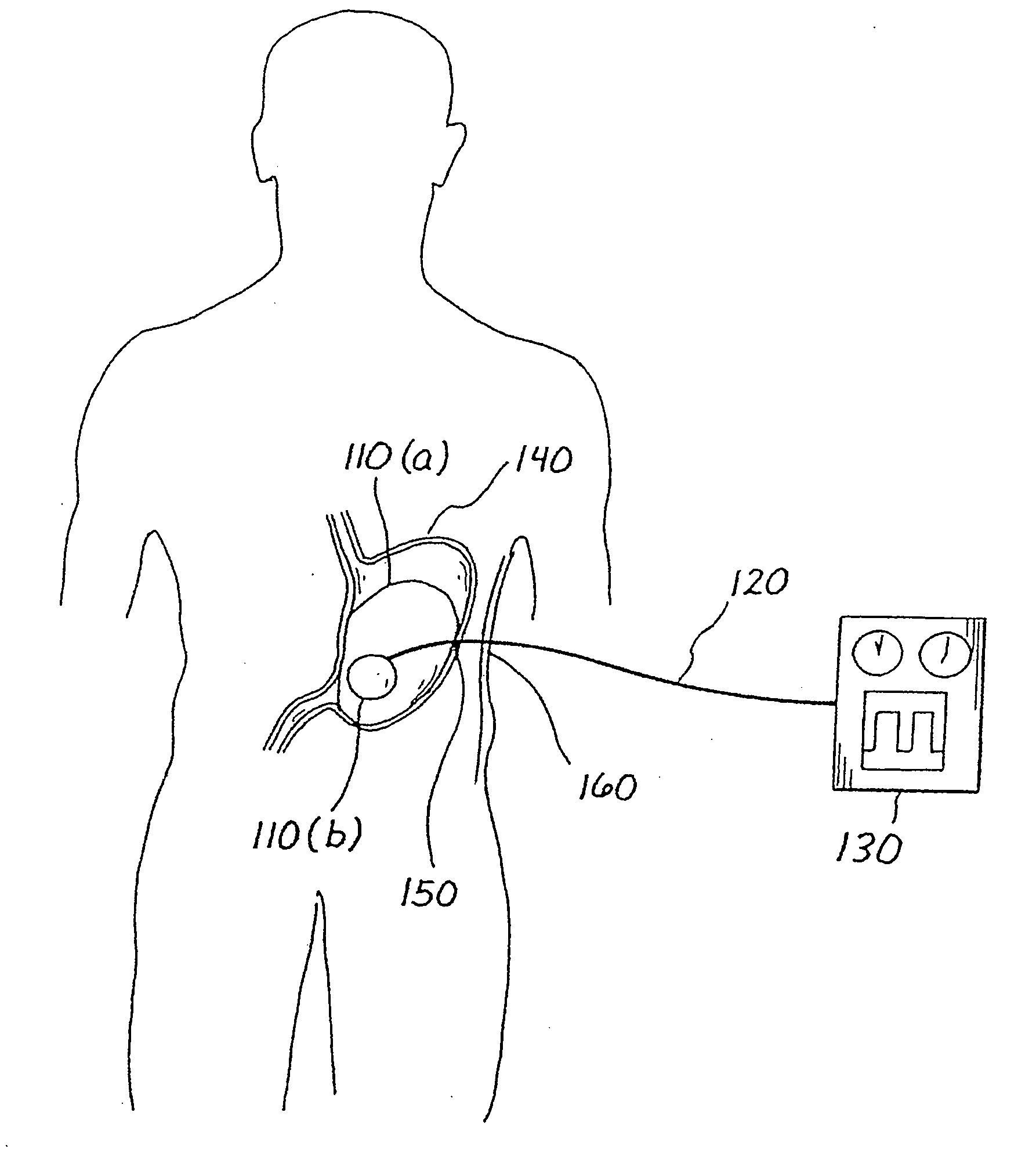 Balloon system and methods for treating obesity